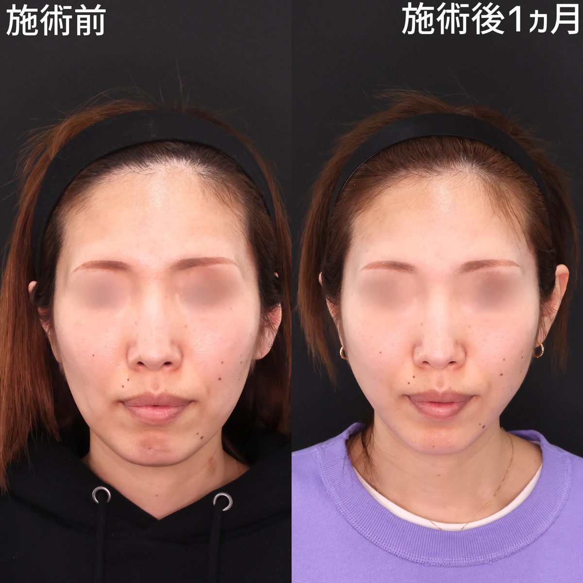 【糸リフト×脂肪除去】たるみを撃退！若々しい印象の小顔へ