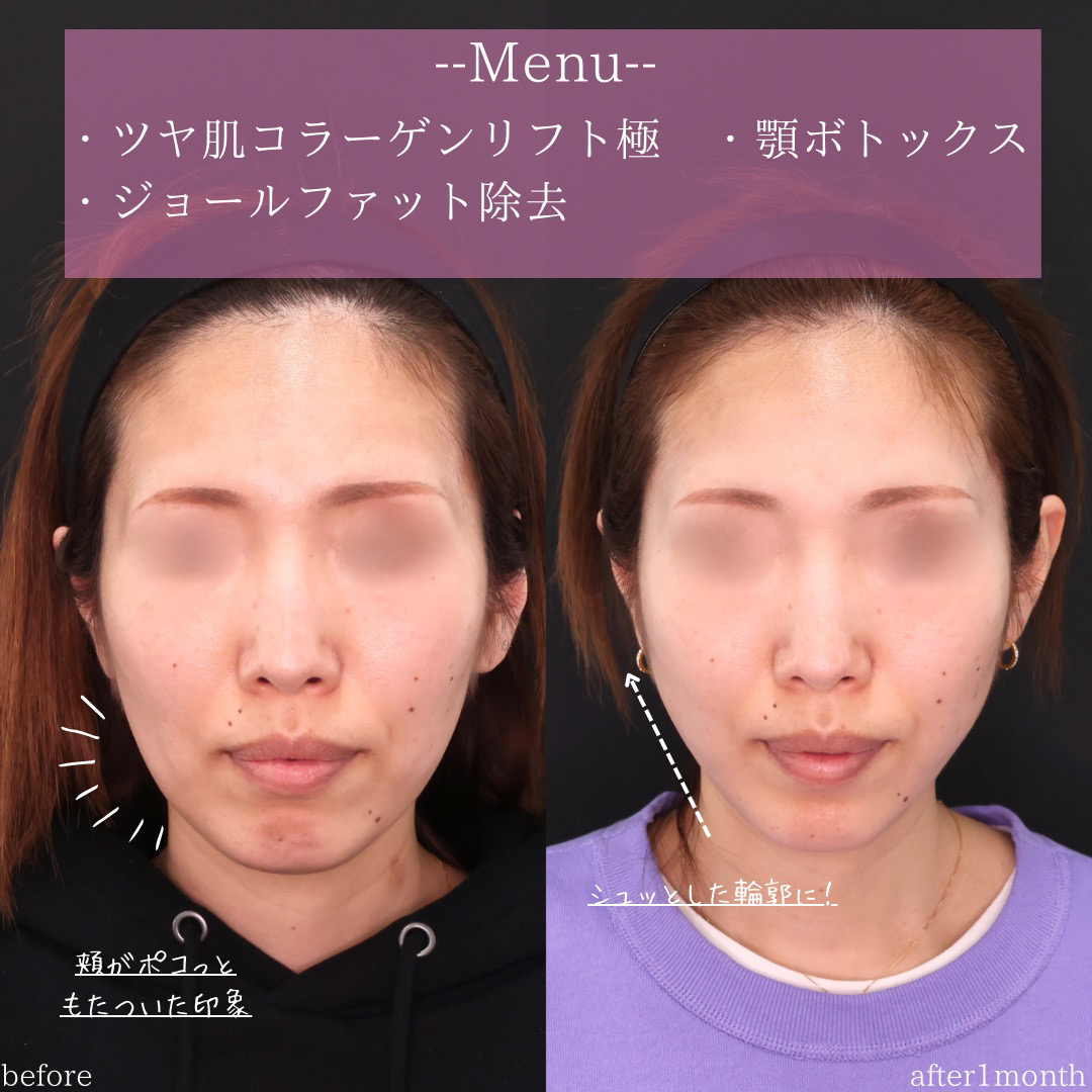 ジョールファット除去/TAC式 ツヤ肌コラーゲンリフト®/ボトックス注射：その他の症例写真 施術前後 