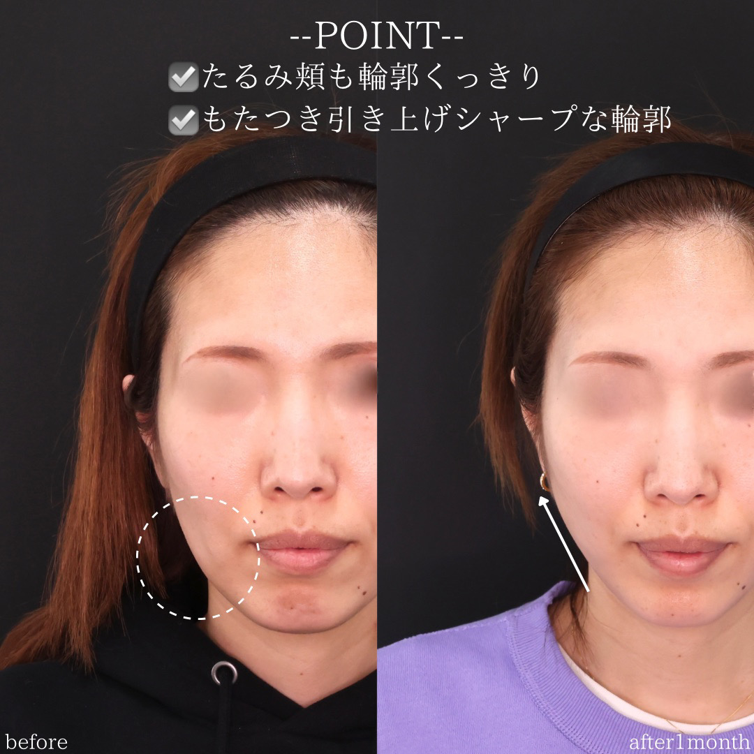 ジョールファット除去/TAC式 ツヤ肌コラーゲンリフト®/ボトックス注射：その他の症例写真 施術前後 
