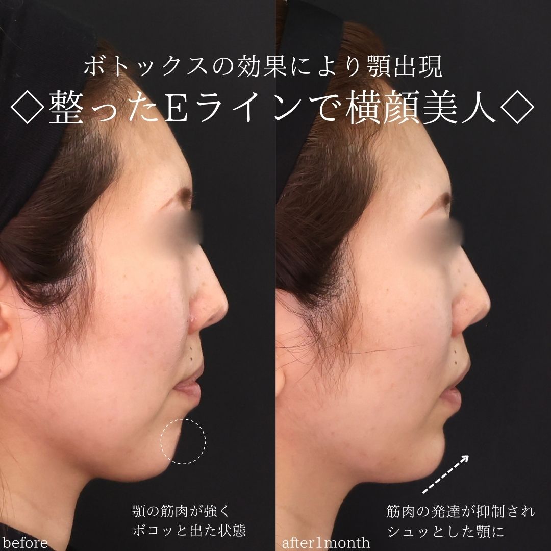 ジョールファット除去/TAC式 ツヤ肌コラーゲンリフト®/ボトックス注射：その他の症例写真 施術前後 