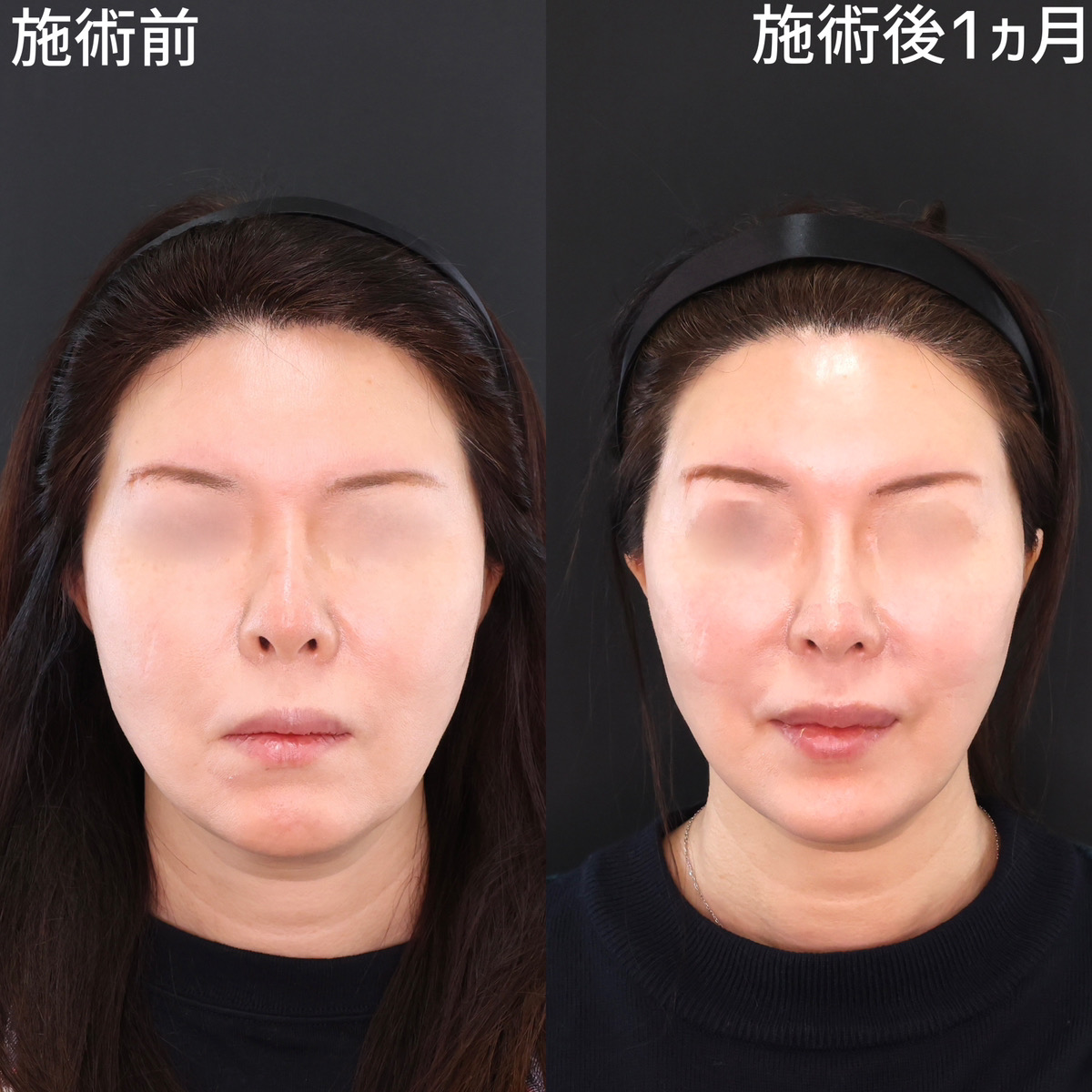 TAC式 ツヤ肌コラーゲンリフト®/ボトックス注射:その他の症例写真 施術前後