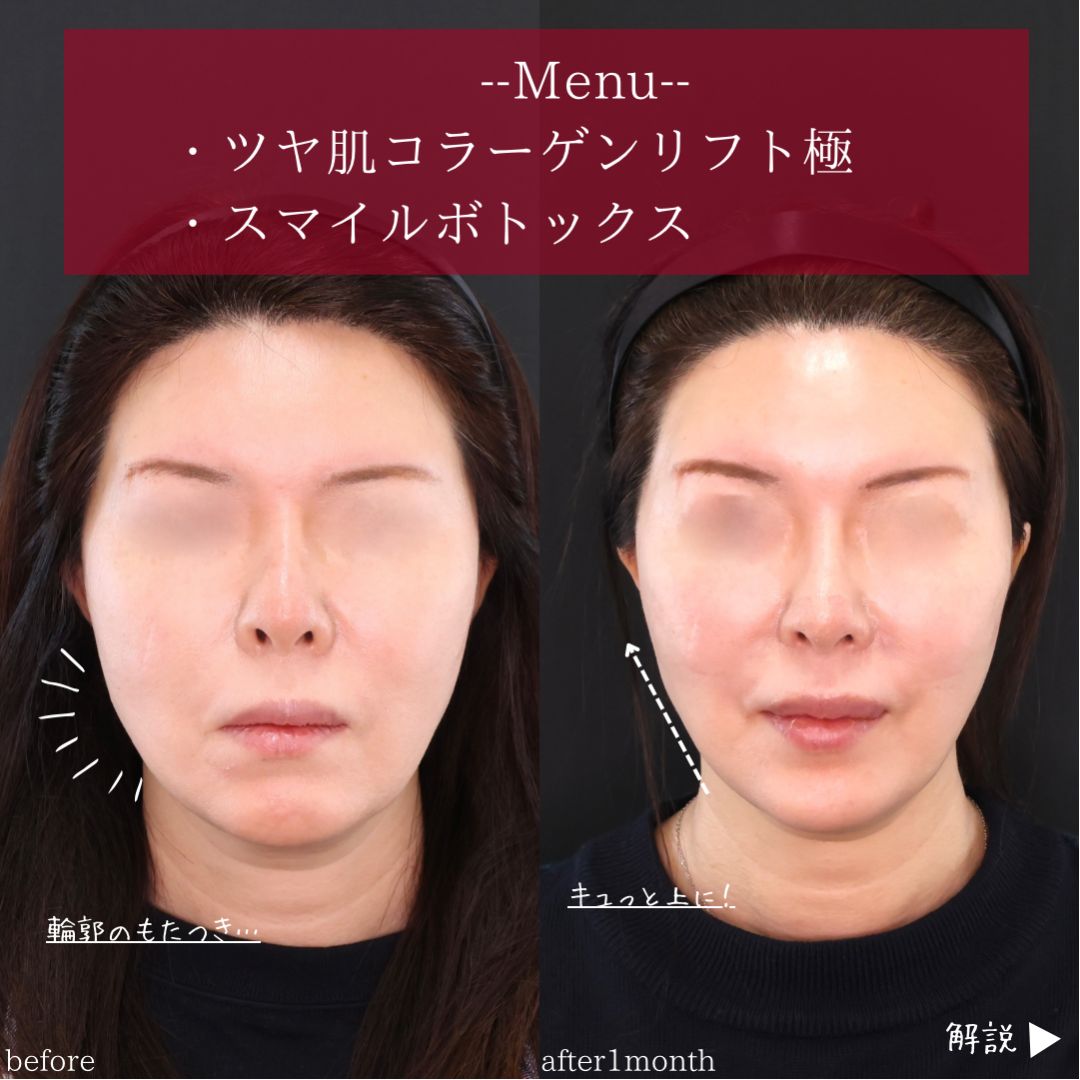 TAC式 ツヤ肌コラーゲンリフト®/ボトックス注射:その他の症例写真 施術前後