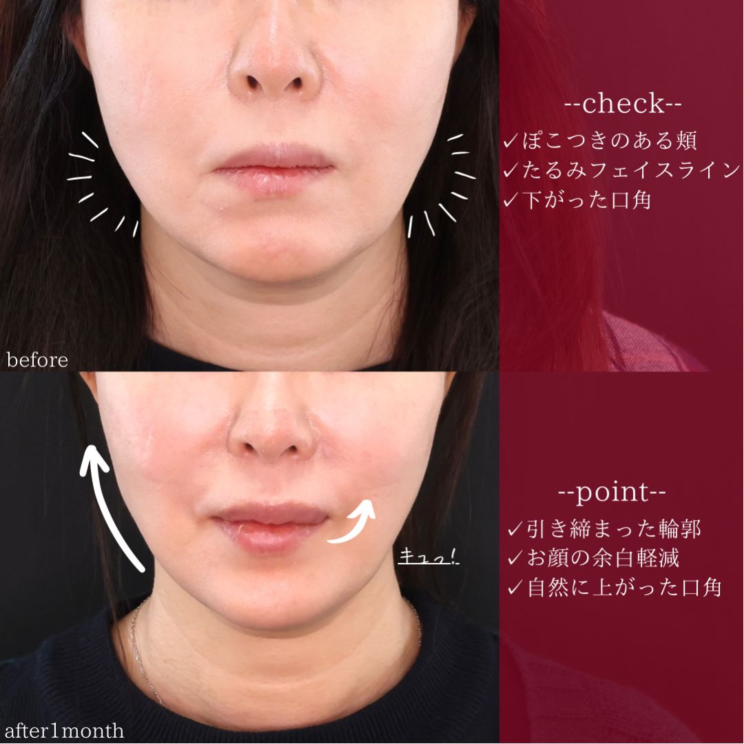TAC式 ツヤ肌コラーゲンリフト®/ボトックス注射:その他の症例写真 施術前後