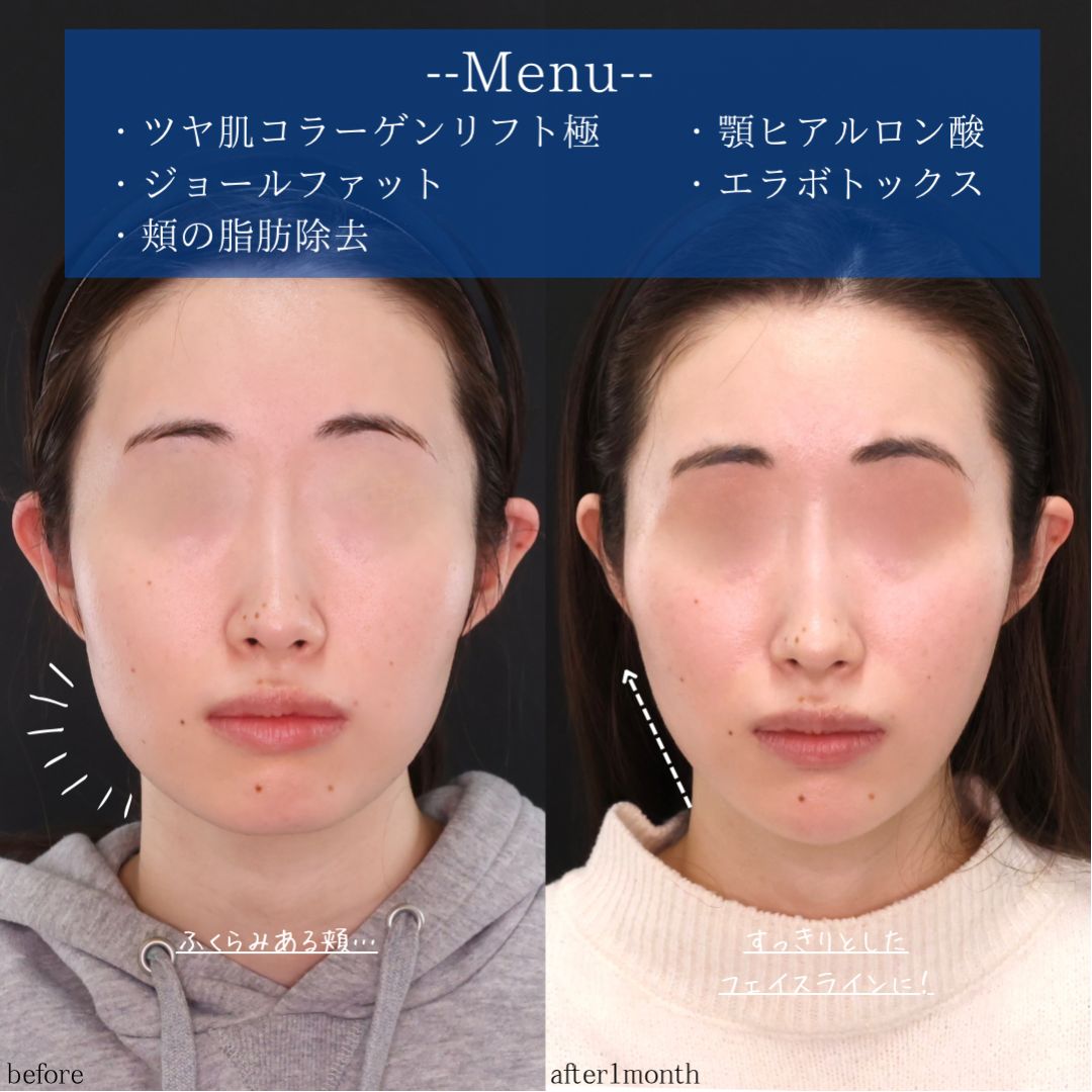 TAC式 ツヤ肌コラーゲンリフト®/ジョールファット除去/顎下の脂肪吸引の症例写真 施術前後 