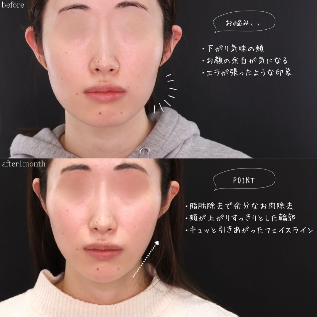 TAC式 ツヤ肌コラーゲンリフト®/ジョールファット除去/顎下の脂肪吸引の症例写真 施術前後 