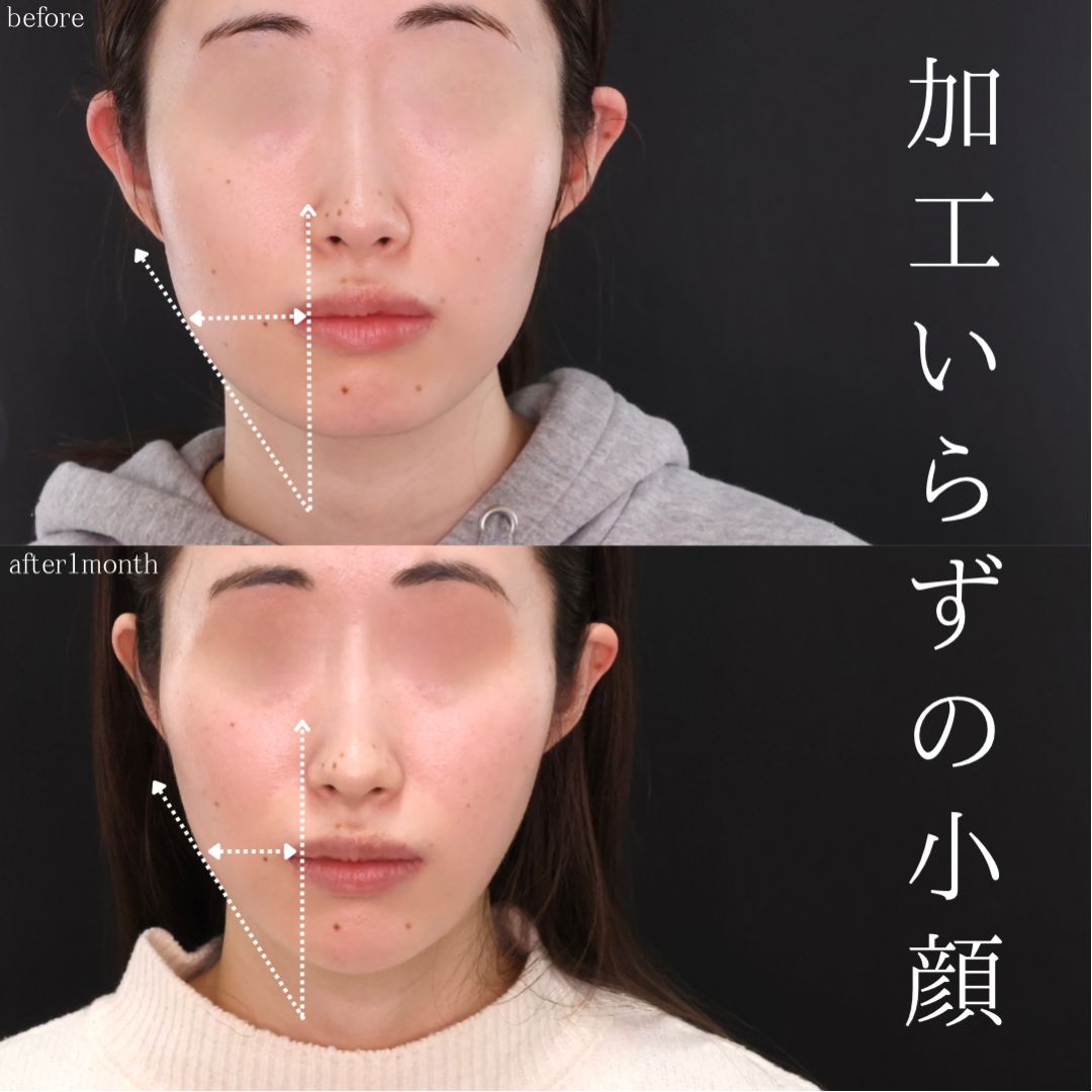 TAC式 ツヤ肌コラーゲンリフト®/ジョールファット除去/顎下の脂肪吸引の症例写真 施術前後 