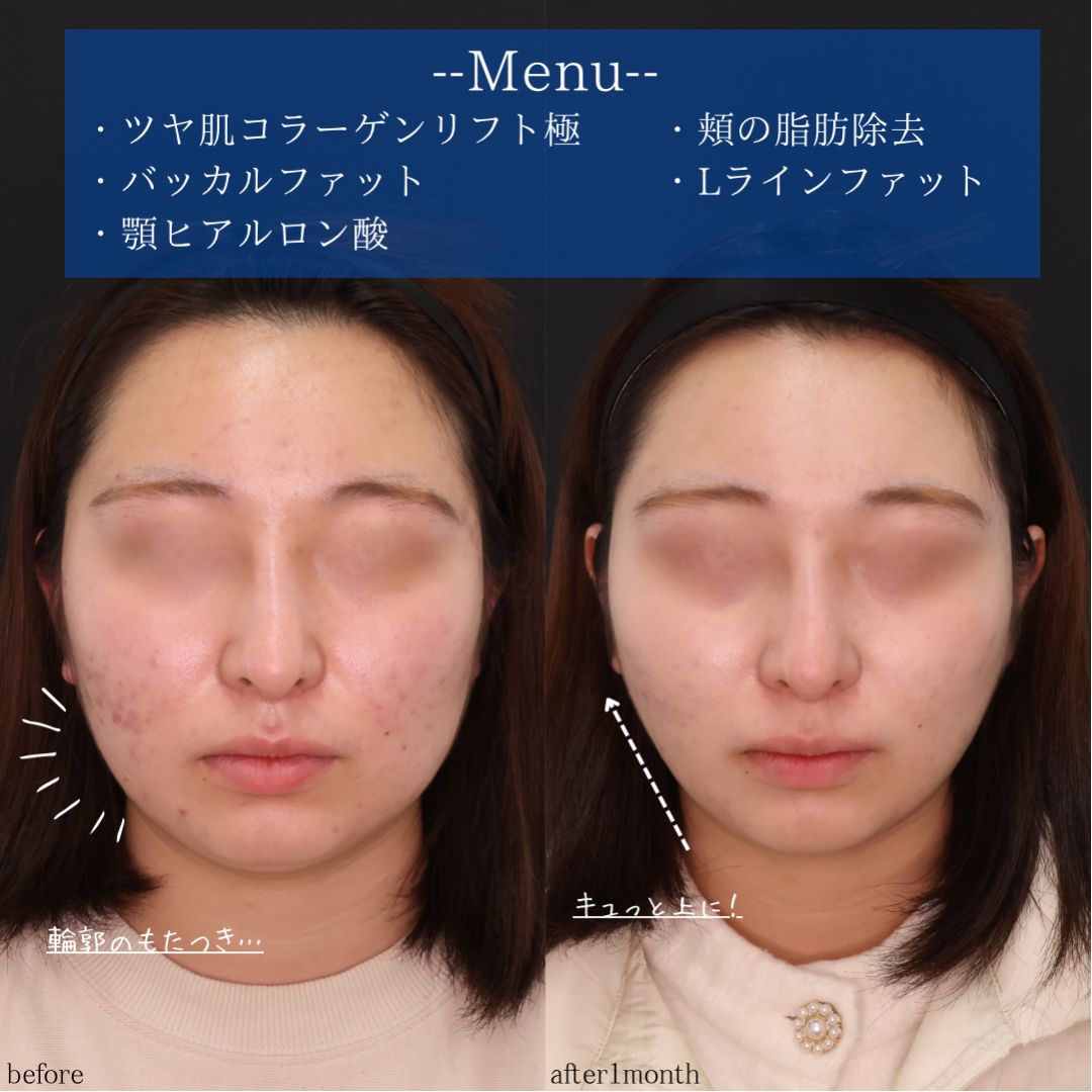 TAC式 ツヤ肌コラーゲンリフト®/顔の脂肪吸引/Lラインファット除去(エラ下脂肪除去)の症例写真 施術前後