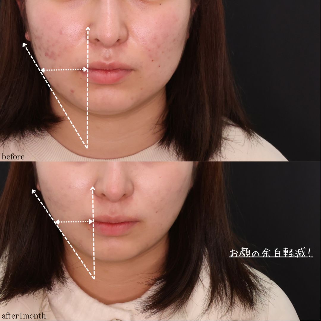 TAC式 ツヤ肌コラーゲンリフト®/顔の脂肪吸引/Lラインファット除去(エラ下脂肪除去)の症例写真 施術前後