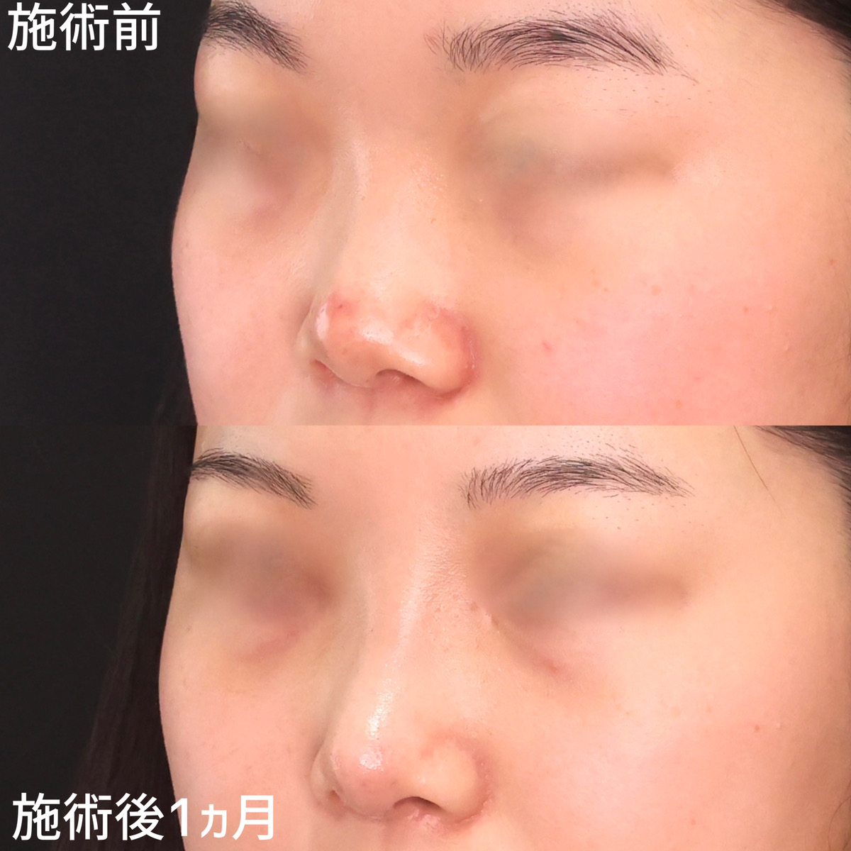 鼻先軟骨移植/隆鼻術(プロテーゼ・自家組織)/鼻尖形成・鼻尖縮小の症例写真 施術前後