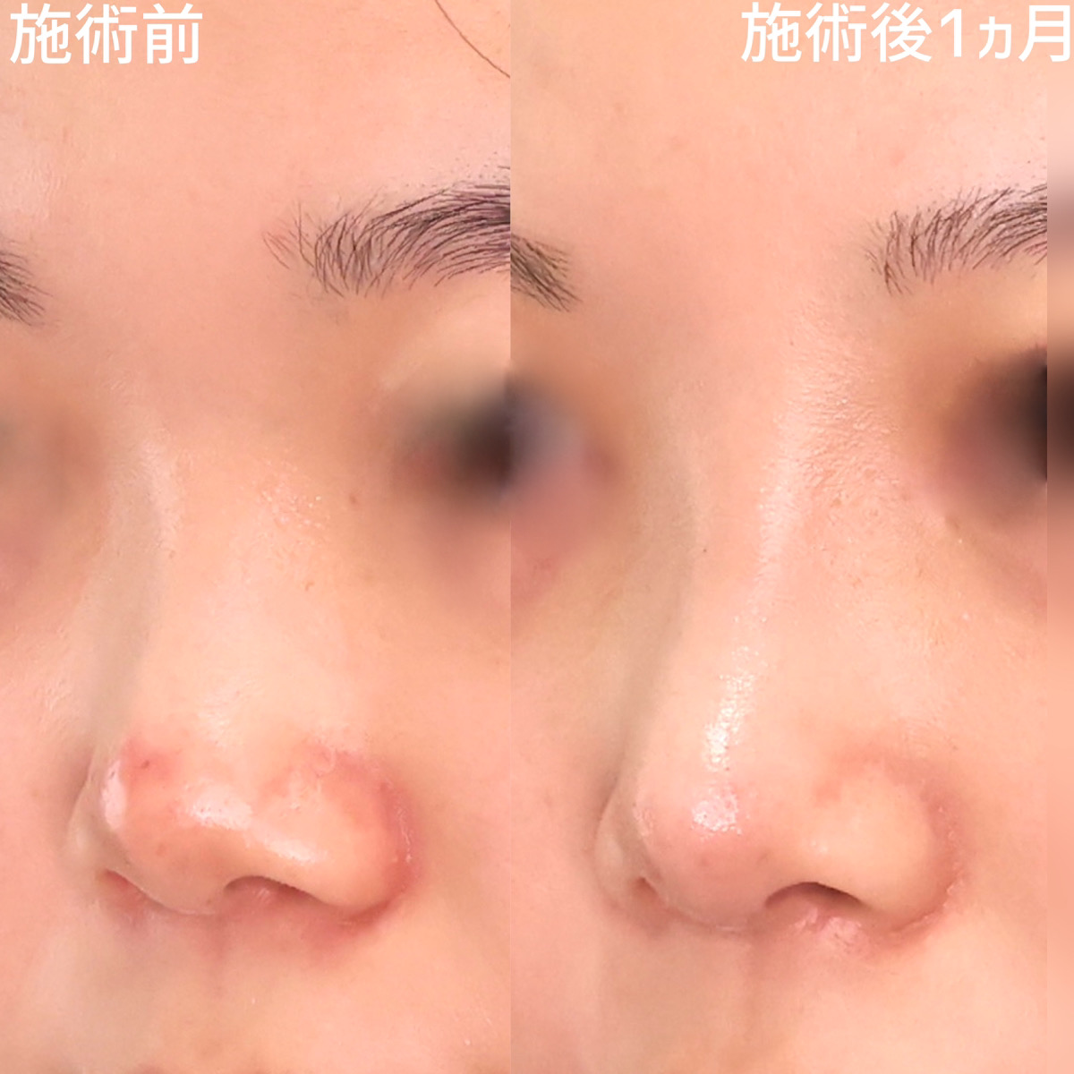 鼻先軟骨移植/隆鼻術(プロテーゼ・自家組織)/鼻尖形成・鼻尖縮小の症例写真 施術前後