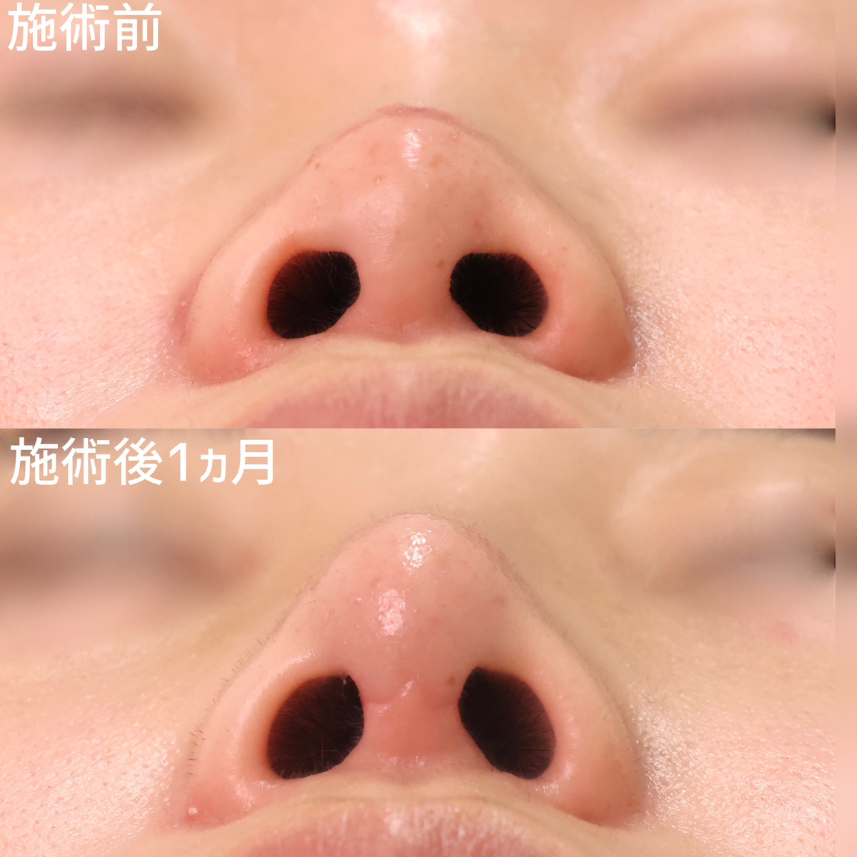 鼻先軟骨移植/隆鼻術(プロテーゼ・自家組織)/鼻尖形成・鼻尖縮小の症例写真 施術前後