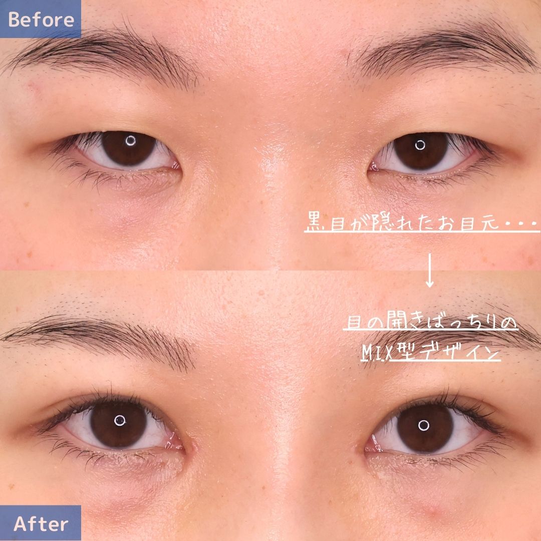 二重埋没法/目頭切開術の症例写真 施術前後 