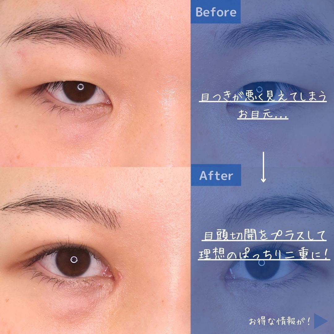 二重埋没法/目頭切開術の症例写真 施術前後 