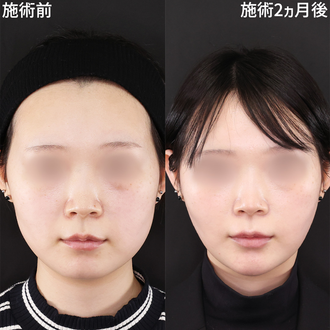 【脂肪除去×糸リフト】で憧れの卵型フェイスラインに
