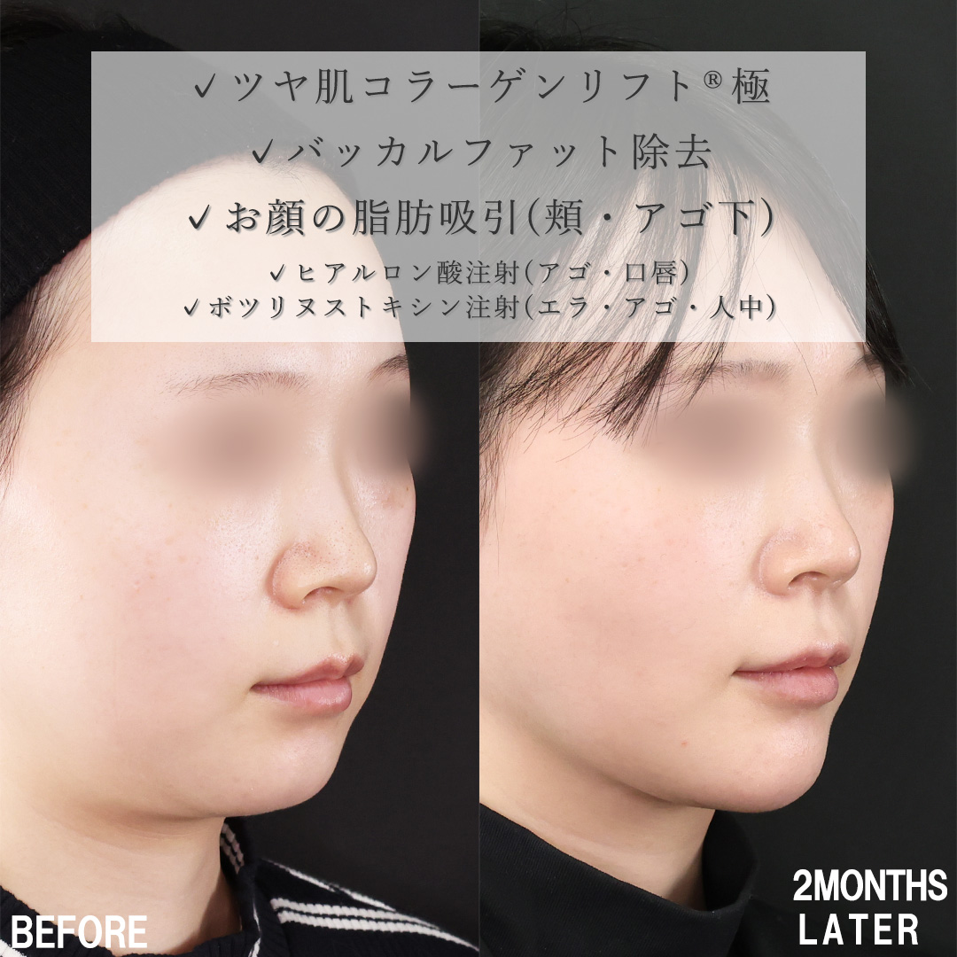 小顔整形｜パーフェクトフェイスライン/TAC式 ツヤ肌コラーゲンリフト®/バッカルファット除去の症例写真 施術前後 