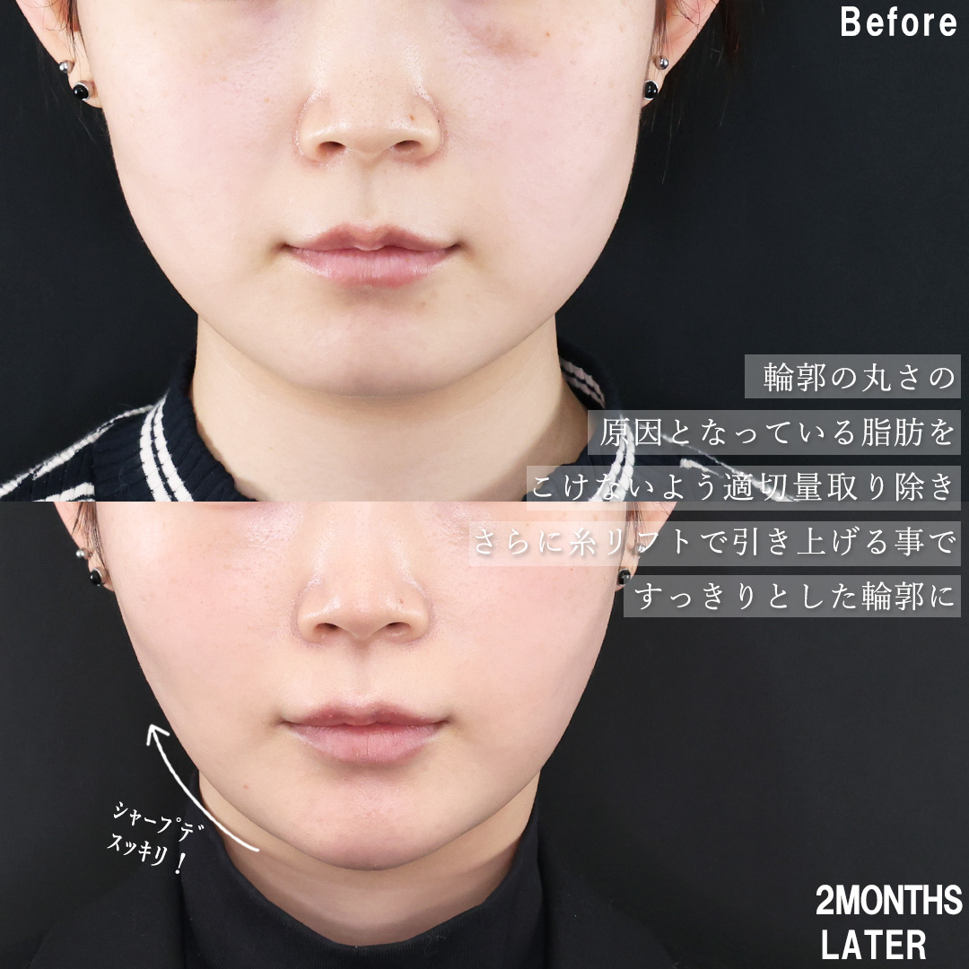 小顔整形｜パーフェクトフェイスライン/TAC式 ツヤ肌コラーゲンリフト®/バッカルファット除去の症例写真 施術前後 