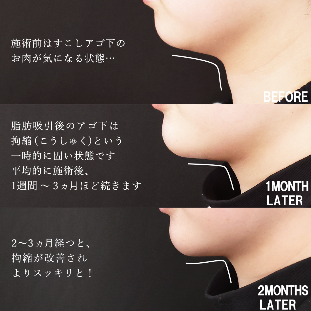 小顔整形｜パーフェクトフェイスライン/TAC式 ツヤ肌コラーゲンリフト®/バッカルファット除去の症例写真 施術前後 