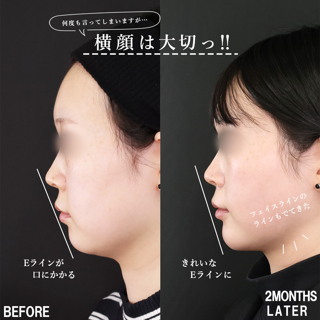 小顔整形｜パーフェクトフェイスライン/TAC式 ツヤ肌コラーゲンリフト®/バッカルファット除去の症例写真 施術前後 