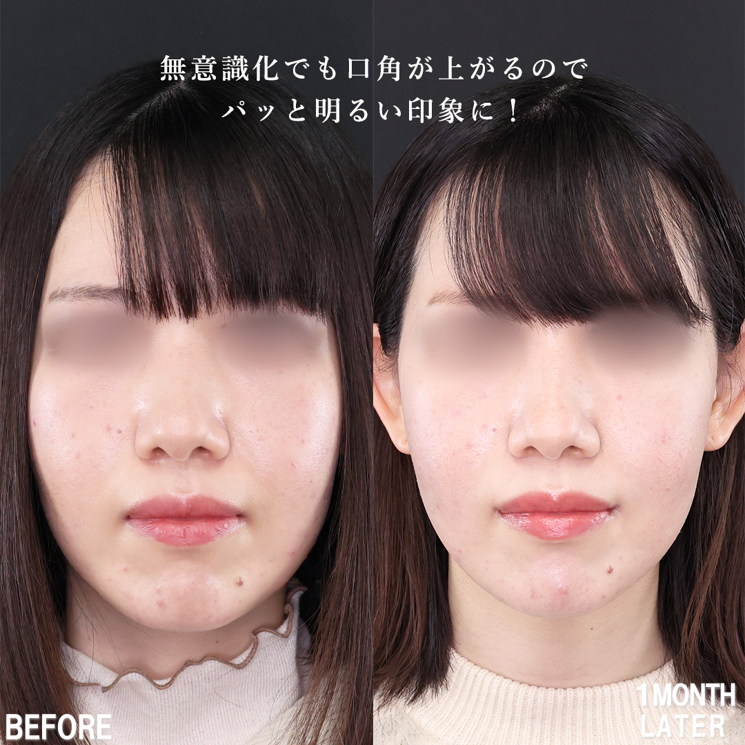口角挙上・リフト（マイクロ切開法・内側法/口内法）の症例写真 施術前後 
