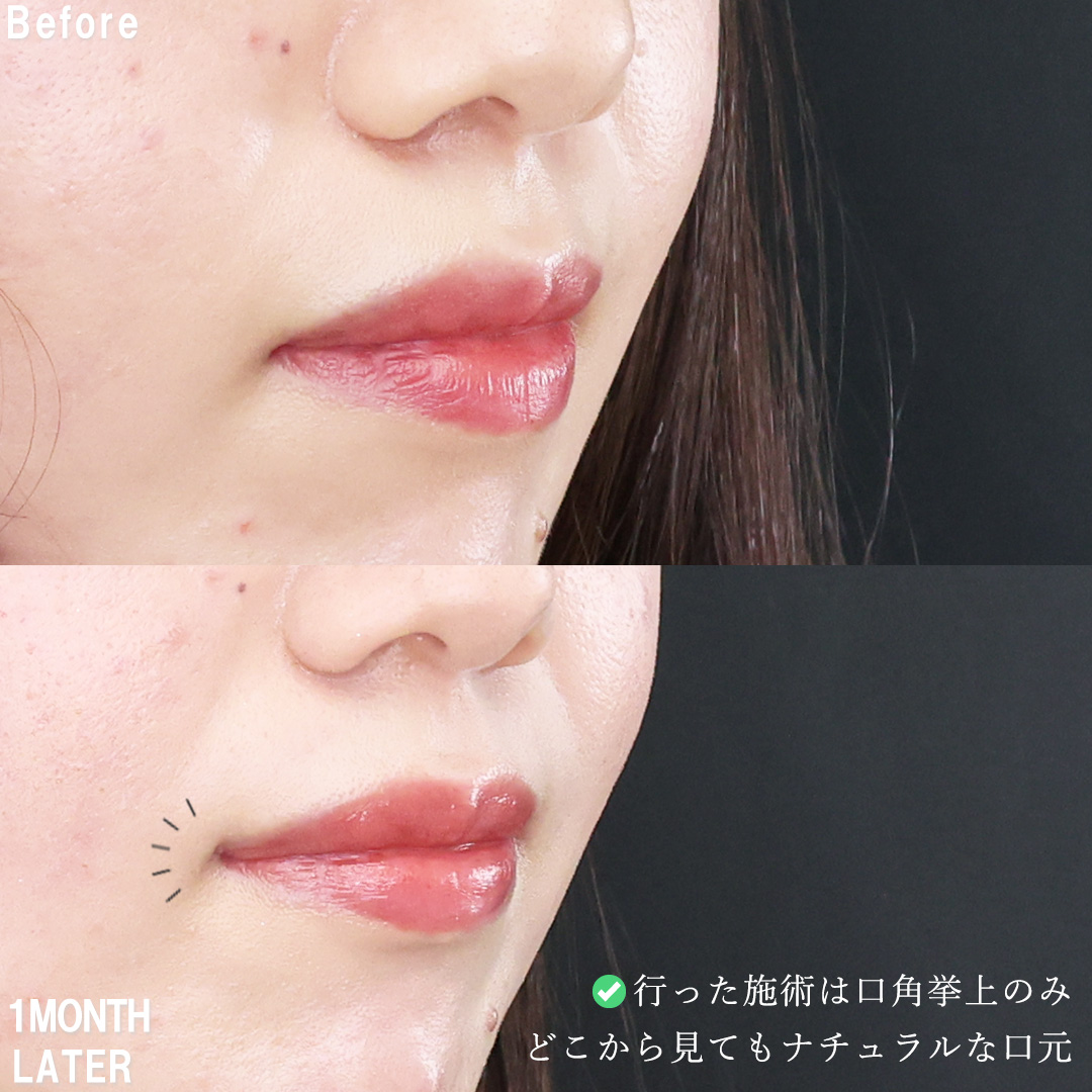 口角挙上・リフト（マイクロ切開法・内側法/口内法）の症例写真 施術前後 