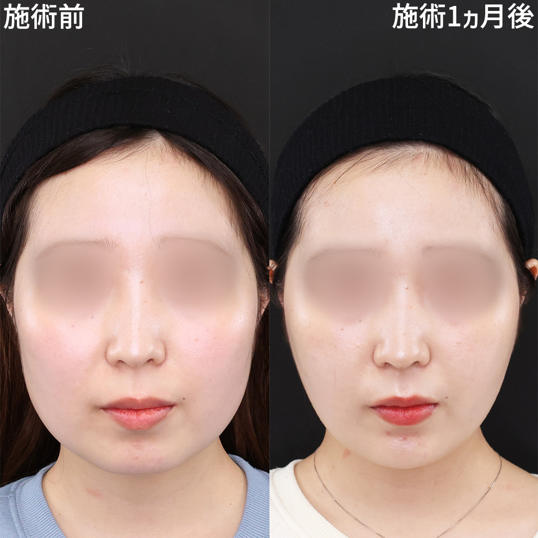 気になる面長感を解消する小顔施術《糸リフト+脂肪除去》