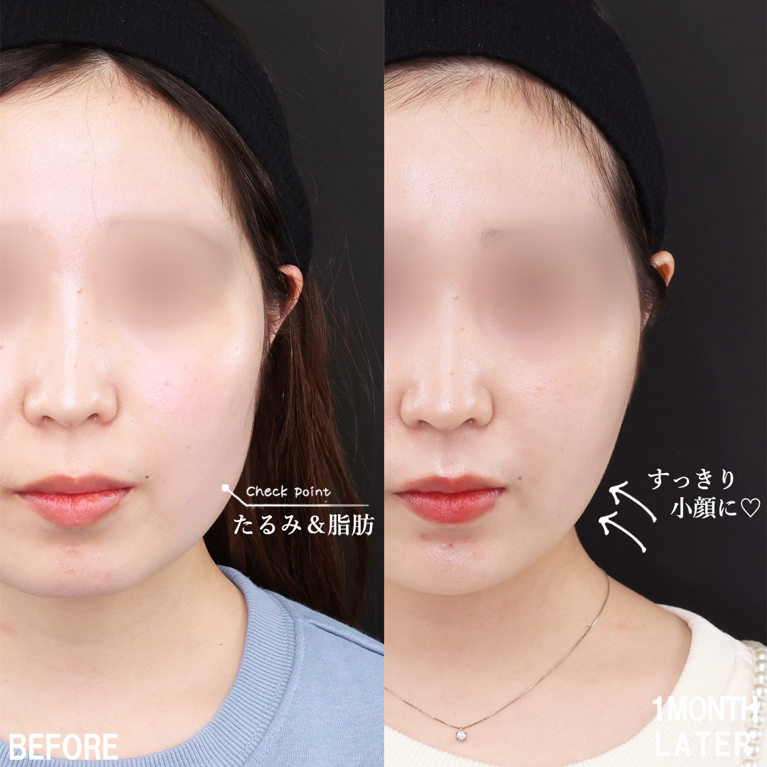 TAC式 ツヤ肌コラーゲンリフト®/メーラーファット除去/Lラインファット除去（エラ下脂肪除去）の症例写真 施術前後 