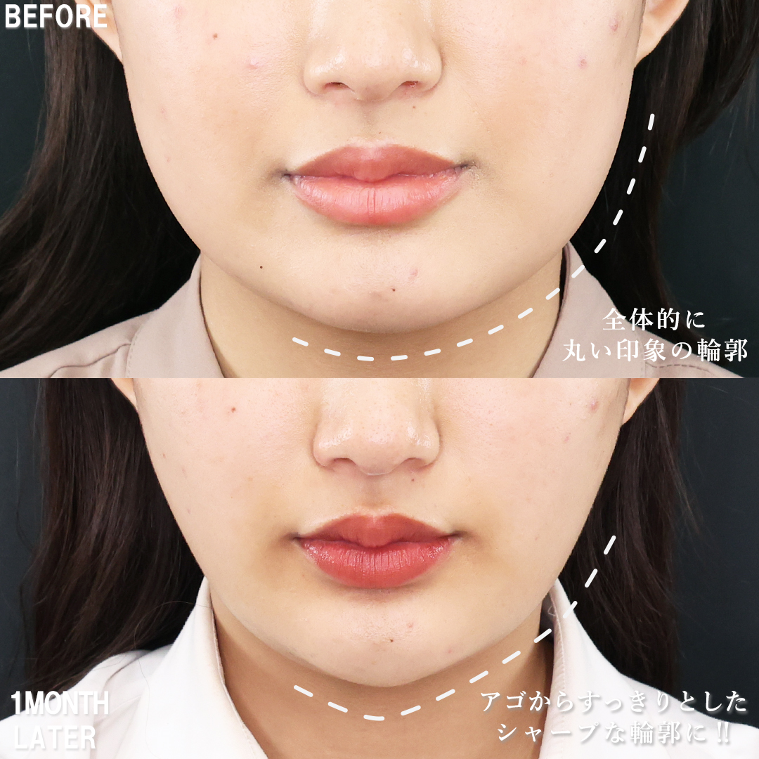 小顔整形｜パーフェクトフェイスライン/顎下の脂肪吸引・顔の脂肪吸引/Lラインファット除去（エラ下脂肪除去）の症例写真 施術前後 