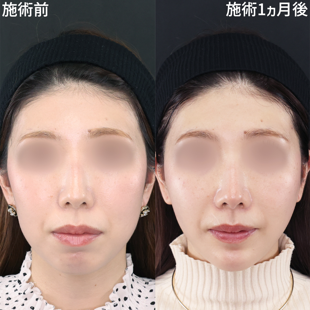 糸リフトでもたつきを解消し すっきりとしたフェイスラインに！