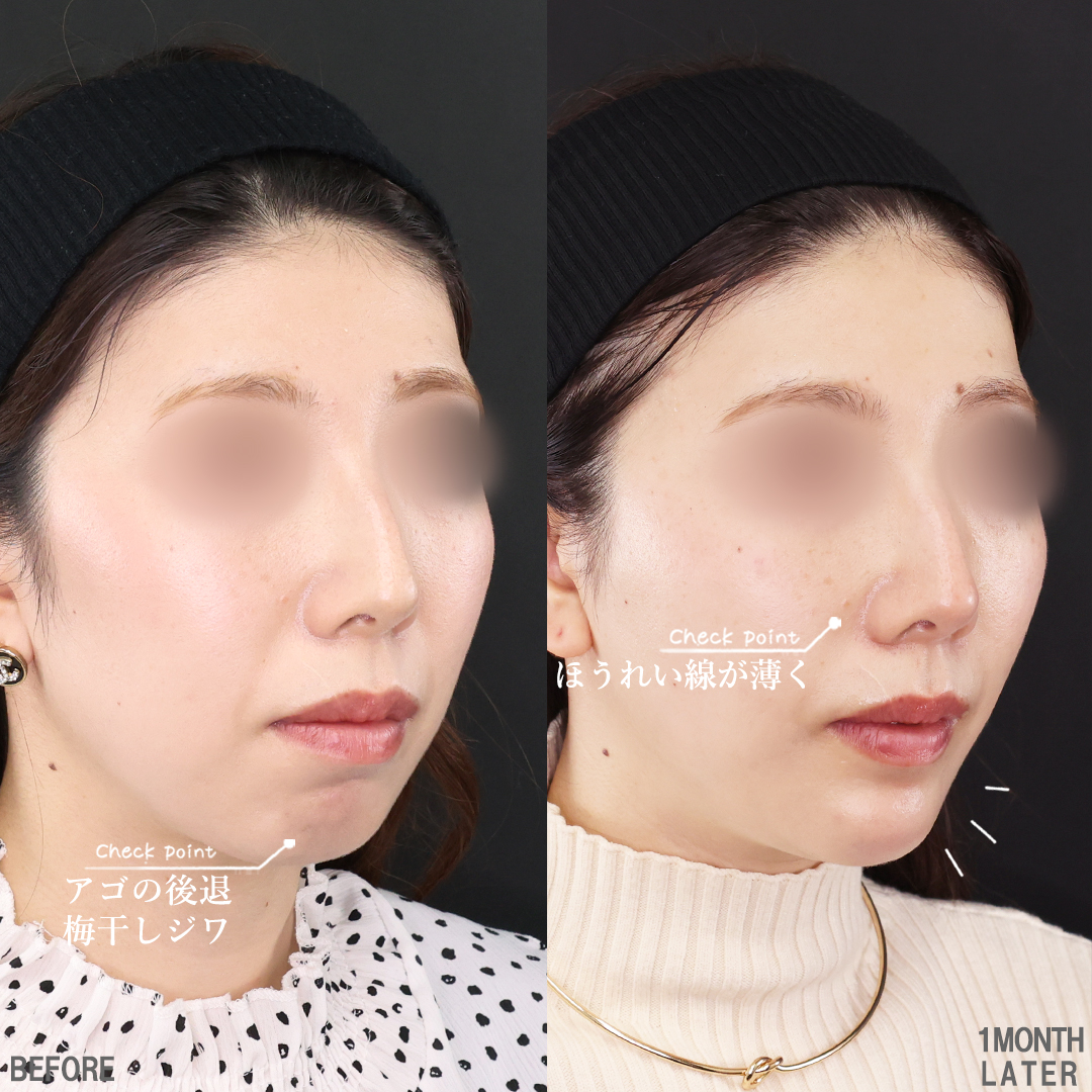 TAC式 ツヤ肌コラーゲンリフト®/顎のヒアルロン酸注射/ほうれい線のヒアルロン酸注射の症例写真 施術前後