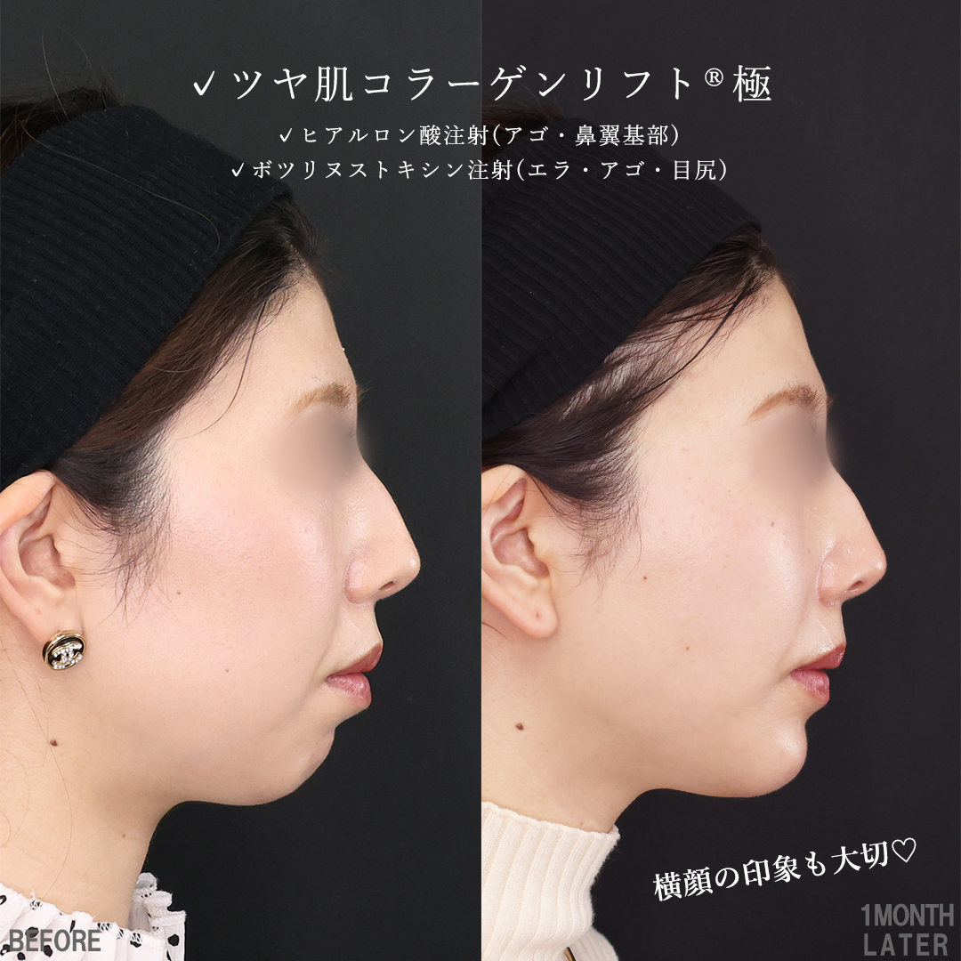 TAC式 ツヤ肌コラーゲンリフト®/顎のヒアルロン酸注射/ほうれい線のヒアルロン酸注射の症例写真 施術前後