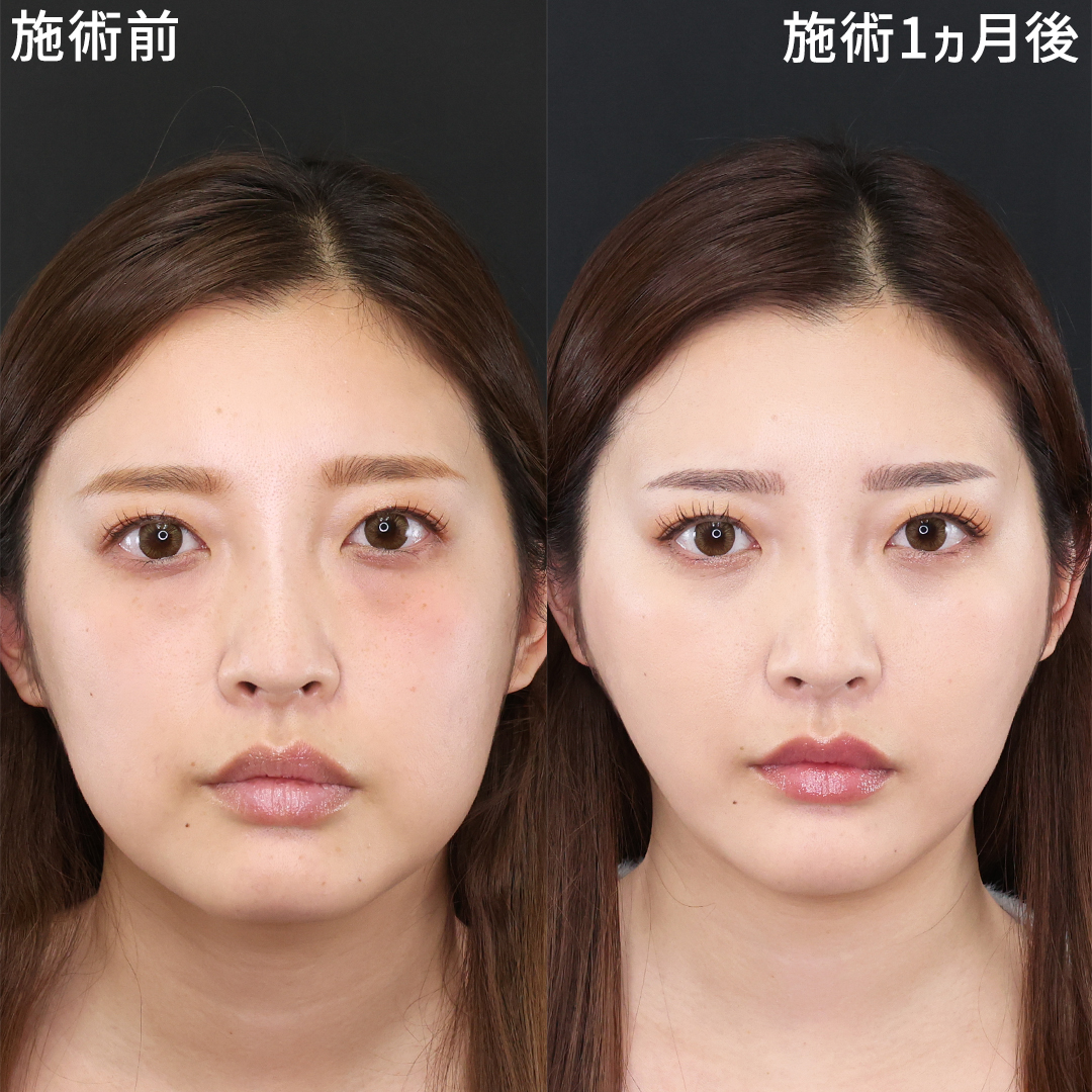 下眼瞼脱脂術(目の下のたるみ取り・目の下の脂肪ふくらみ取り)/TAC式 ツヤ肌コラーゲンリフト®/顔の脂肪吸引の症例写真 施術前後