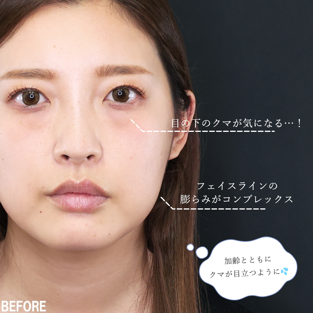 下眼瞼脱脂術(目の下のたるみ取り・目の下の脂肪ふくらみ取り)/TAC式 ツヤ肌コラーゲンリフト®/顔の脂肪吸引の症例写真 施術前後