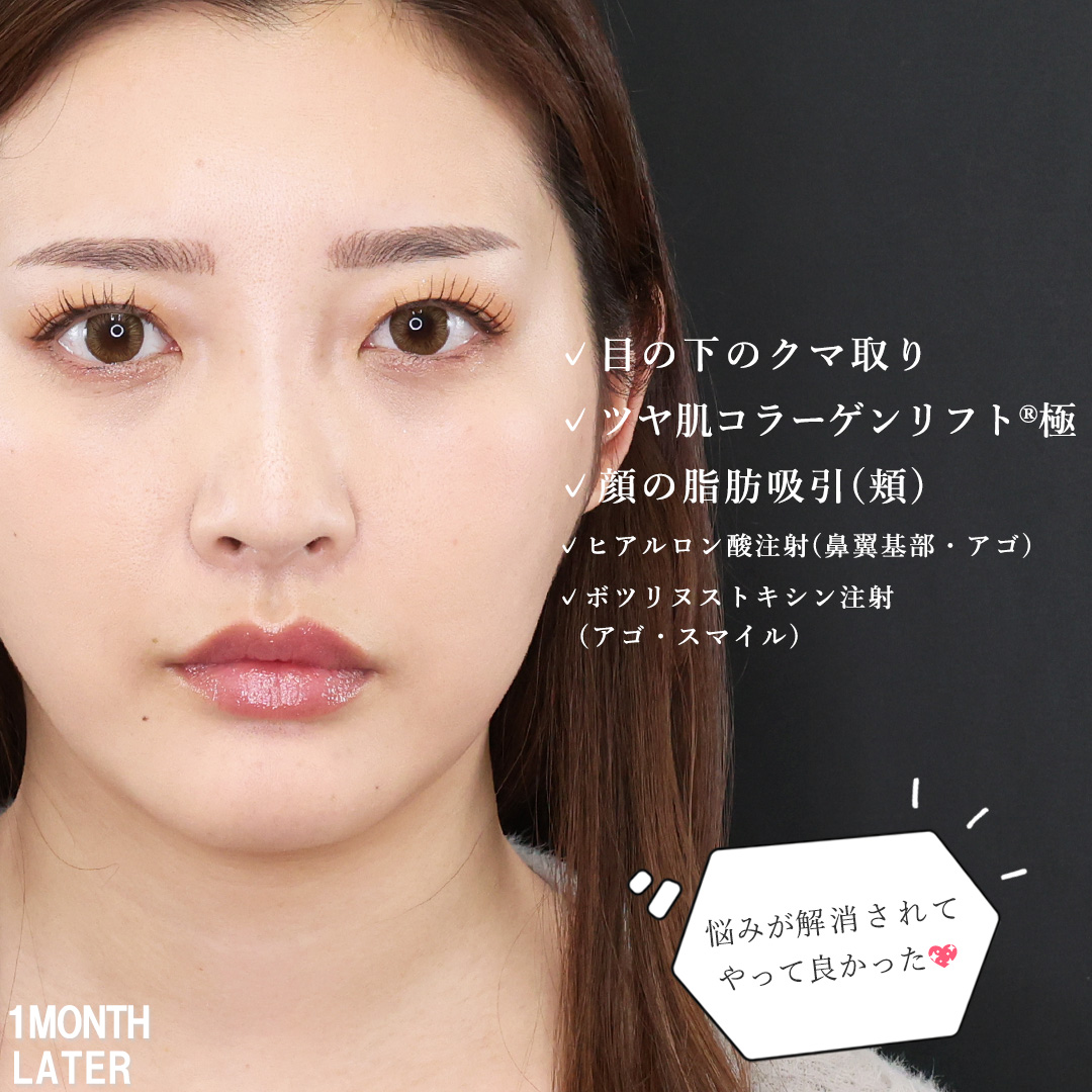 下眼瞼脱脂術(目の下のたるみ取り・目の下の脂肪ふくらみ取り)/TAC式 ツヤ肌コラーゲンリフト®/顔の脂肪吸引の症例写真 施術前後