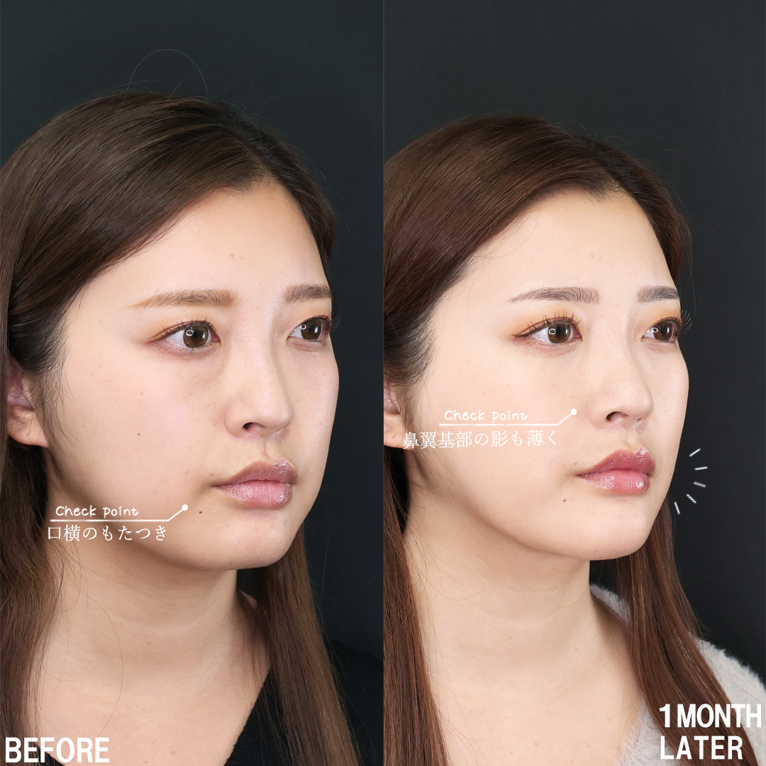 下眼瞼脱脂術(目の下のたるみ取り・目の下の脂肪ふくらみ取り)/TAC式 ツヤ肌コラーゲンリフト®/顔の脂肪吸引の症例写真 施術前後