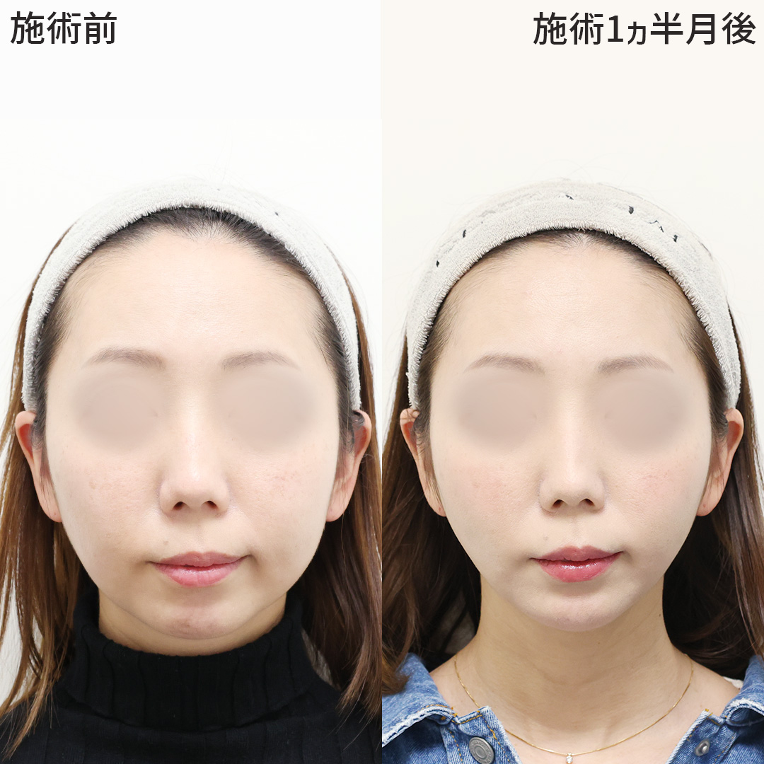 【エイジングケアとしても人気】パーフェクトフェイスライン