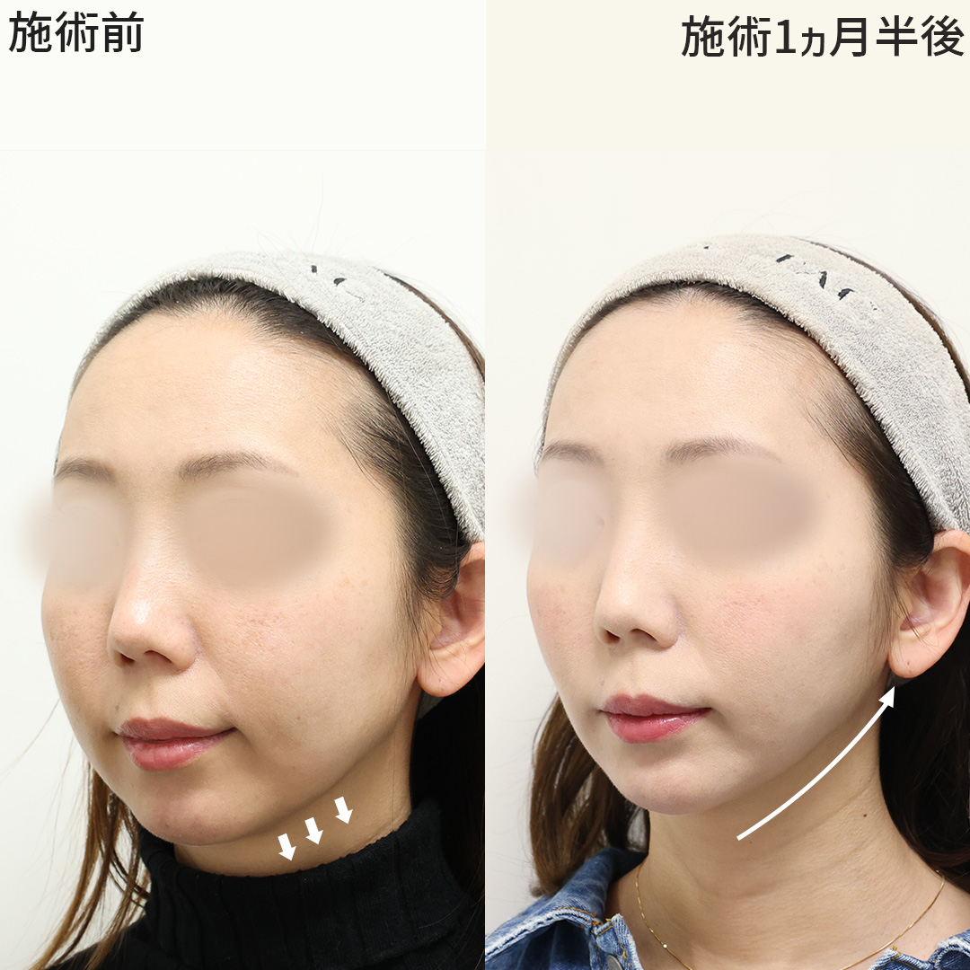 小顔整形｜パーフェクトフェイスライン/ジョールファット除去/Lラインファット除去（エラ下脂肪除去）の症例写真 施術前後 