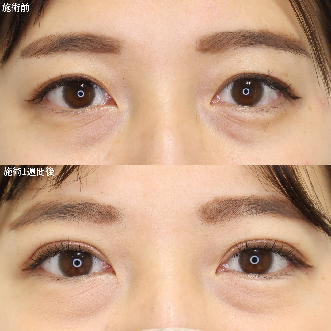 大人可愛い二重になりたい方へ