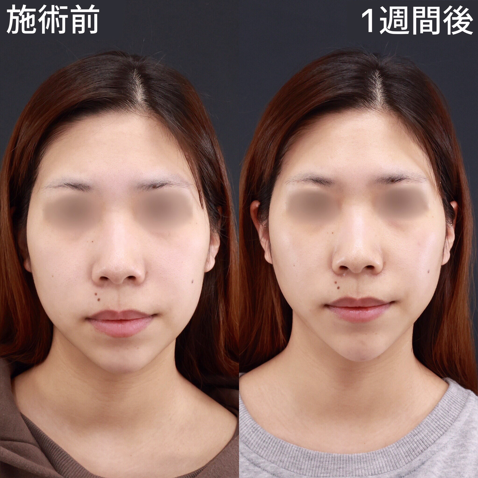 【パーフェクトフェイスライン】もともと小顔の方でも、より小顔に！