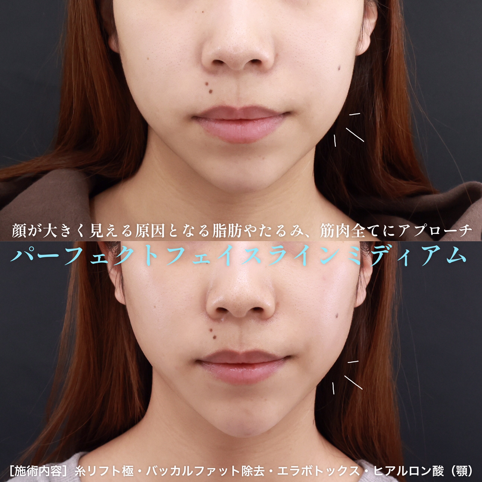 小顔整形｜パーフェクトフェイスライン/TAC式 ツヤ肌コラーゲンリフト®/バッカルファット除去の症例写真 施術前後 