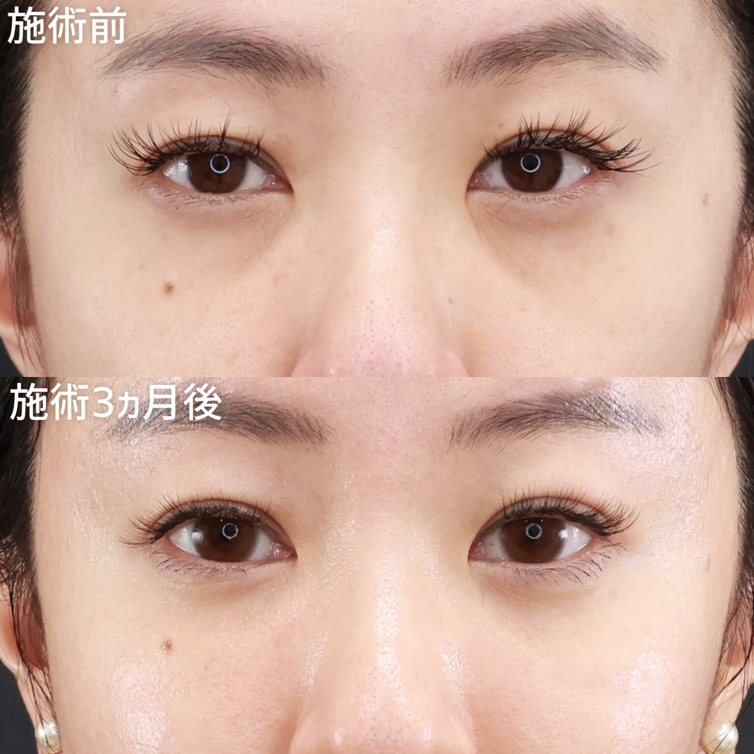 【下眼瞼脱脂術＋脂肪注入】疲れ見え・老け見えする自分から卒業！