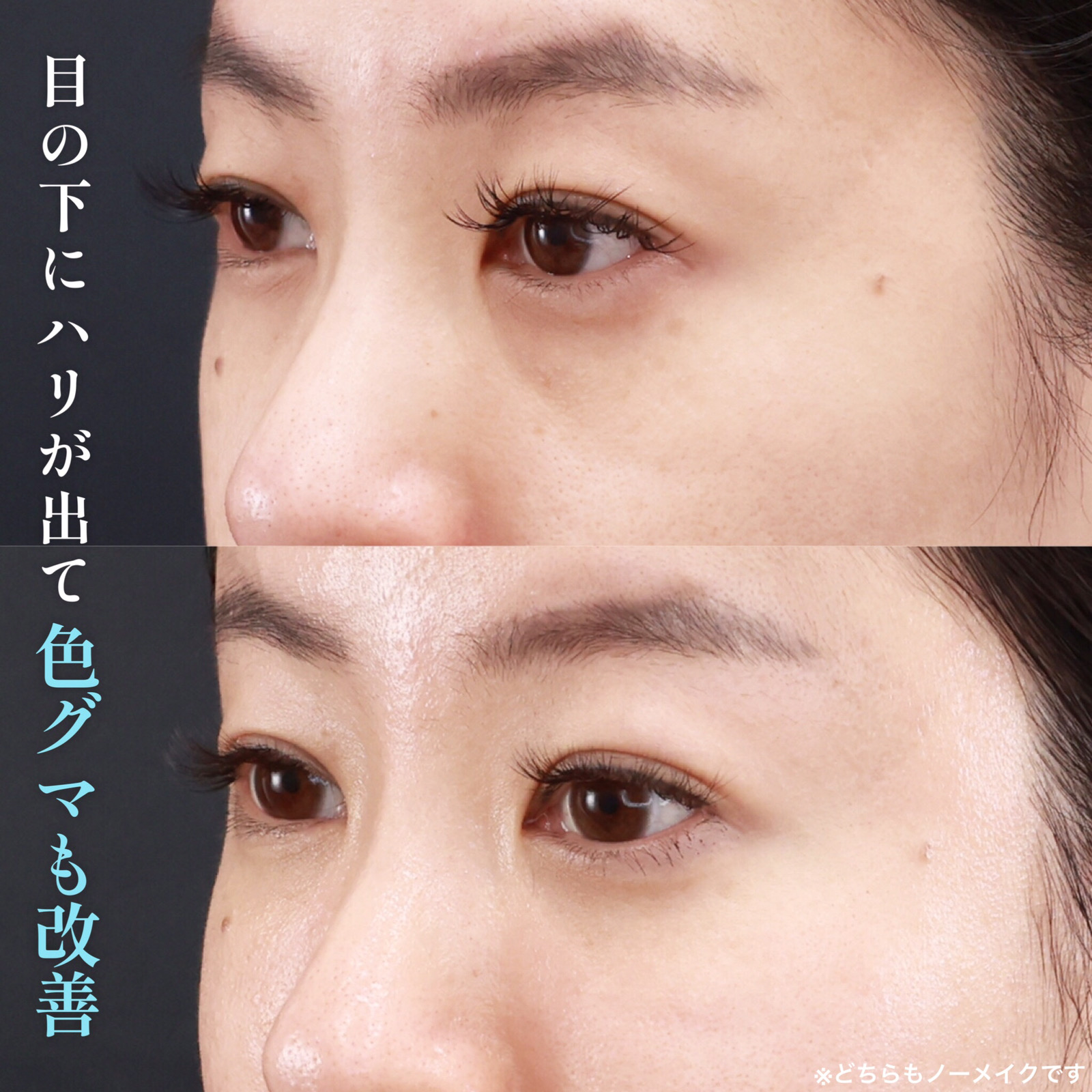 下眼瞼脱脂術（目の下のたるみ取り・目の下の脂肪ふくらみ取り）/顔の脂肪注入(コンデンスリッチフェイス)の症例写真 施術前後 