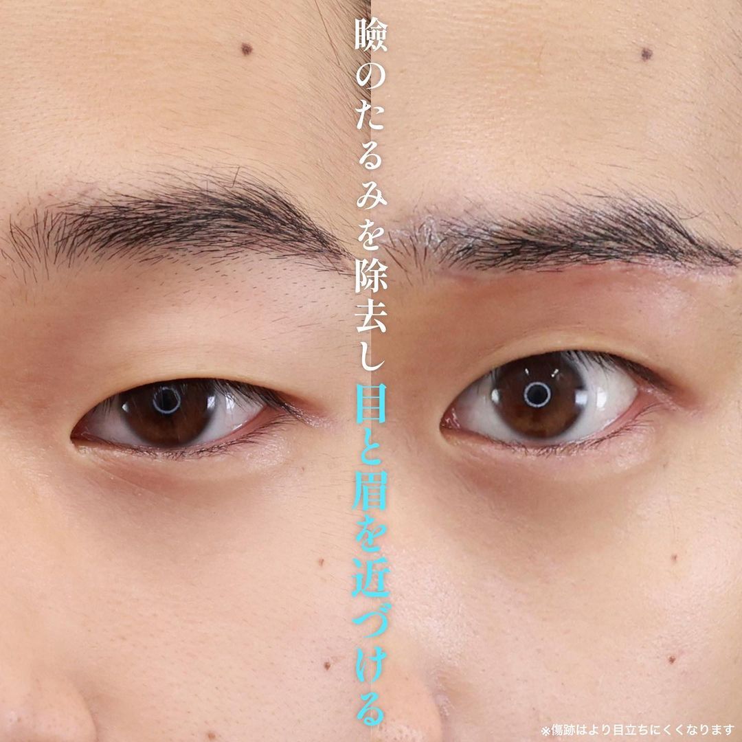 眉毛下切開術の症例写真 施術前後 