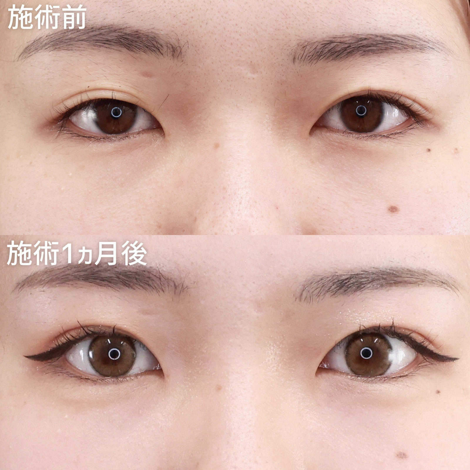 【クイックコスメリング】腫れにくいうえに取れにくい！生まれつきのような二重が長く続く。