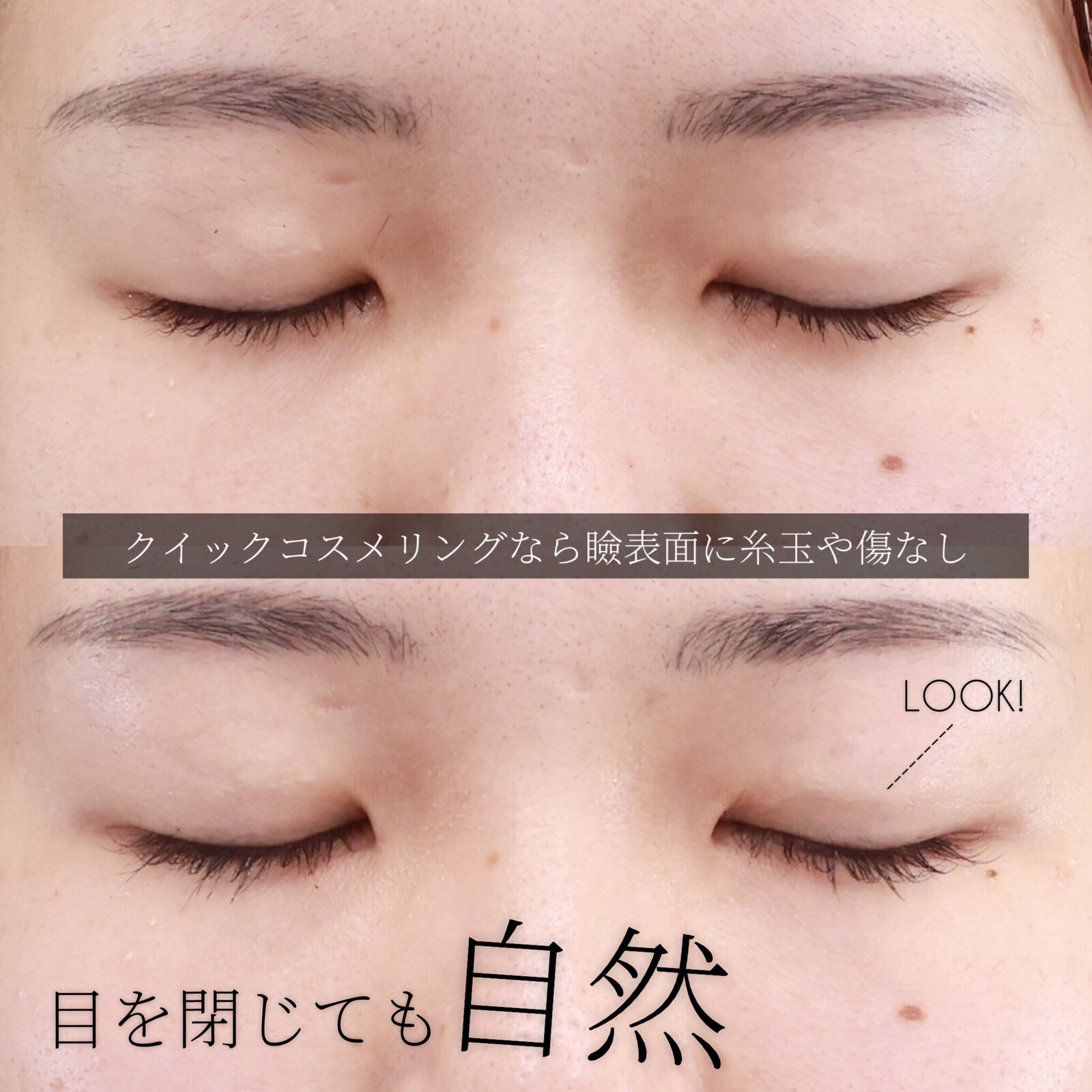 クイックコスメリングの症例写真 施術前後 