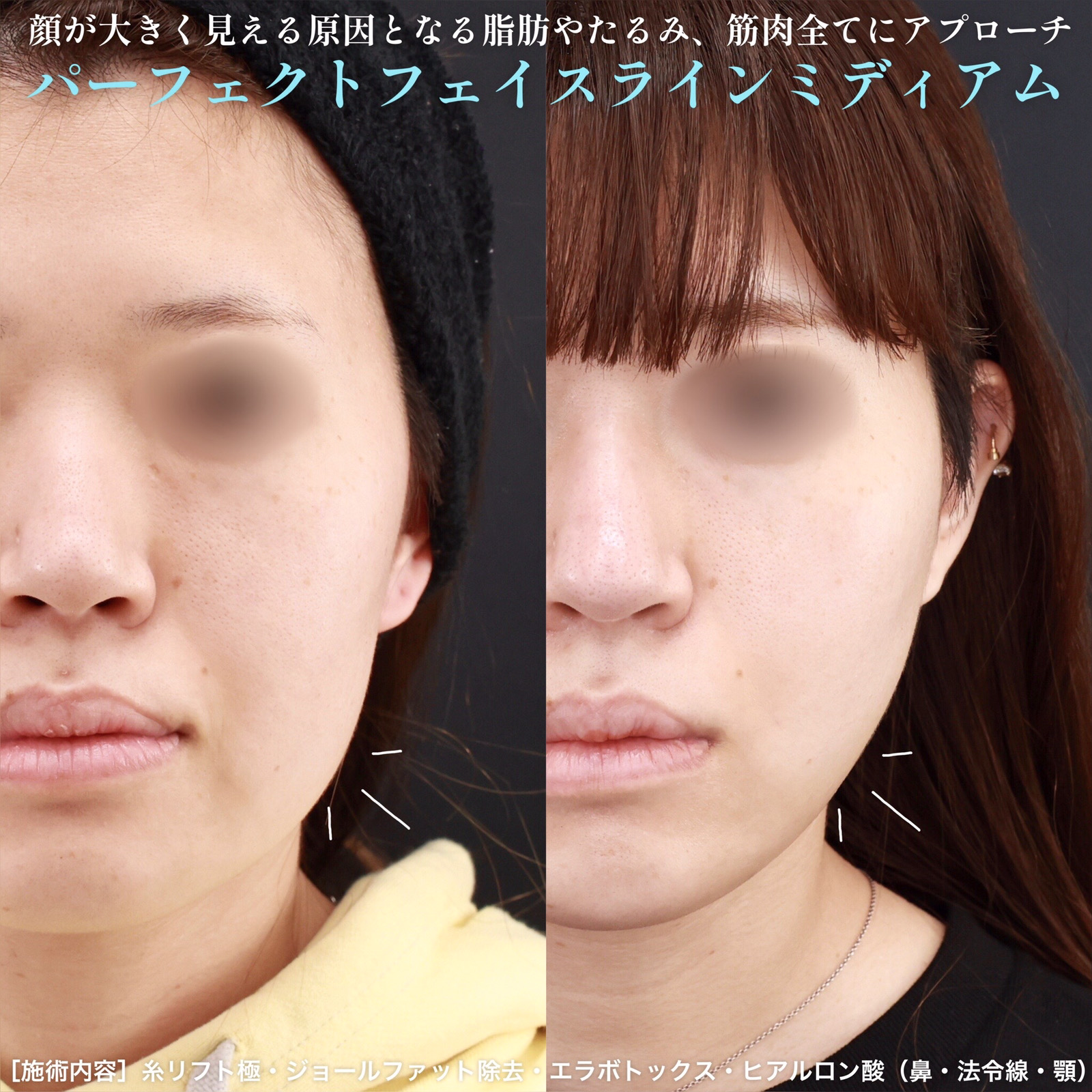 小顔整形|パーフェクトフェイスライン/ジョールファット除去/TAC式 ツヤ肌コラーゲンリフト®の症例写真 施術前後