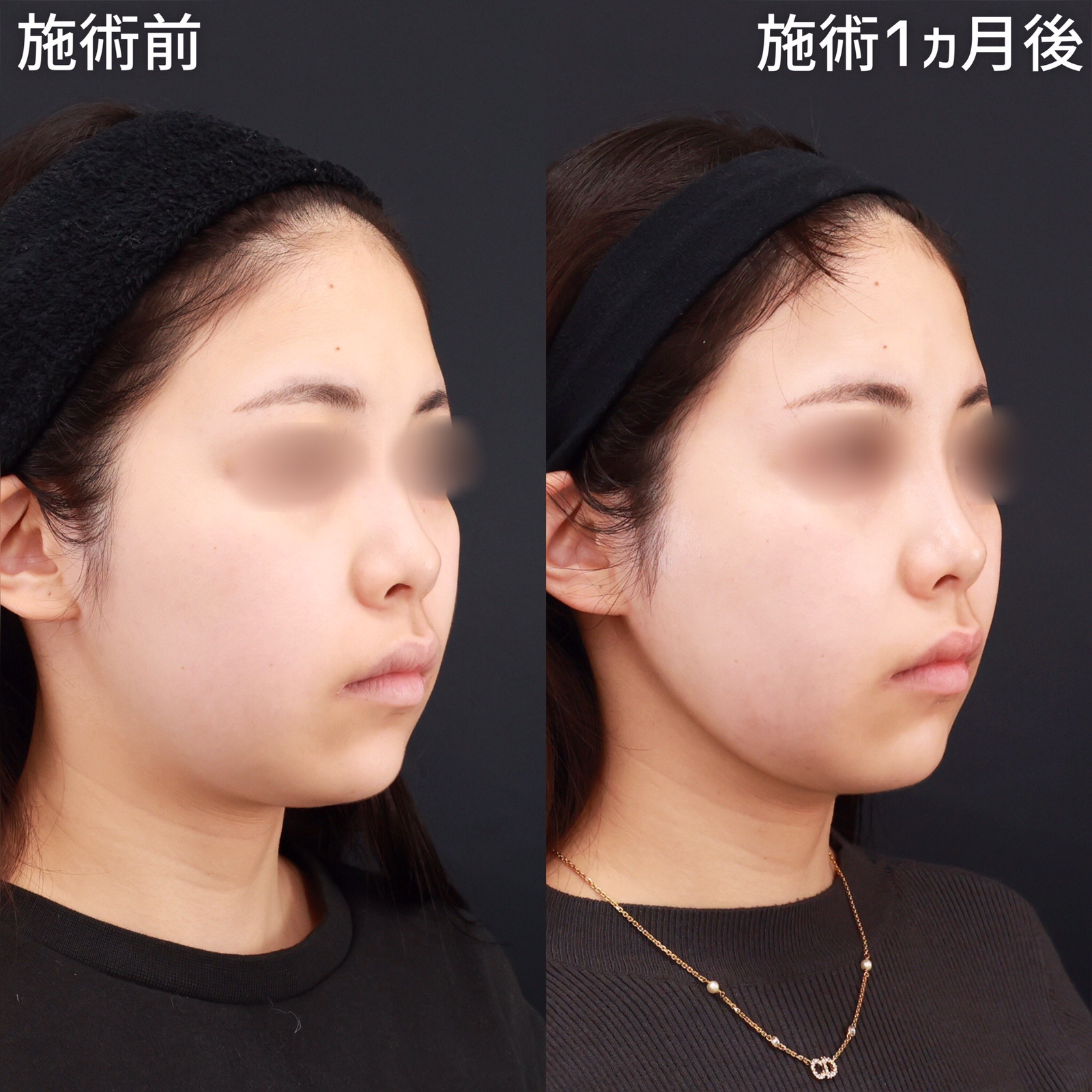 【顔の脂肪吸引】若々しさを残しつつスッキリとしたシャープな輪郭を形成