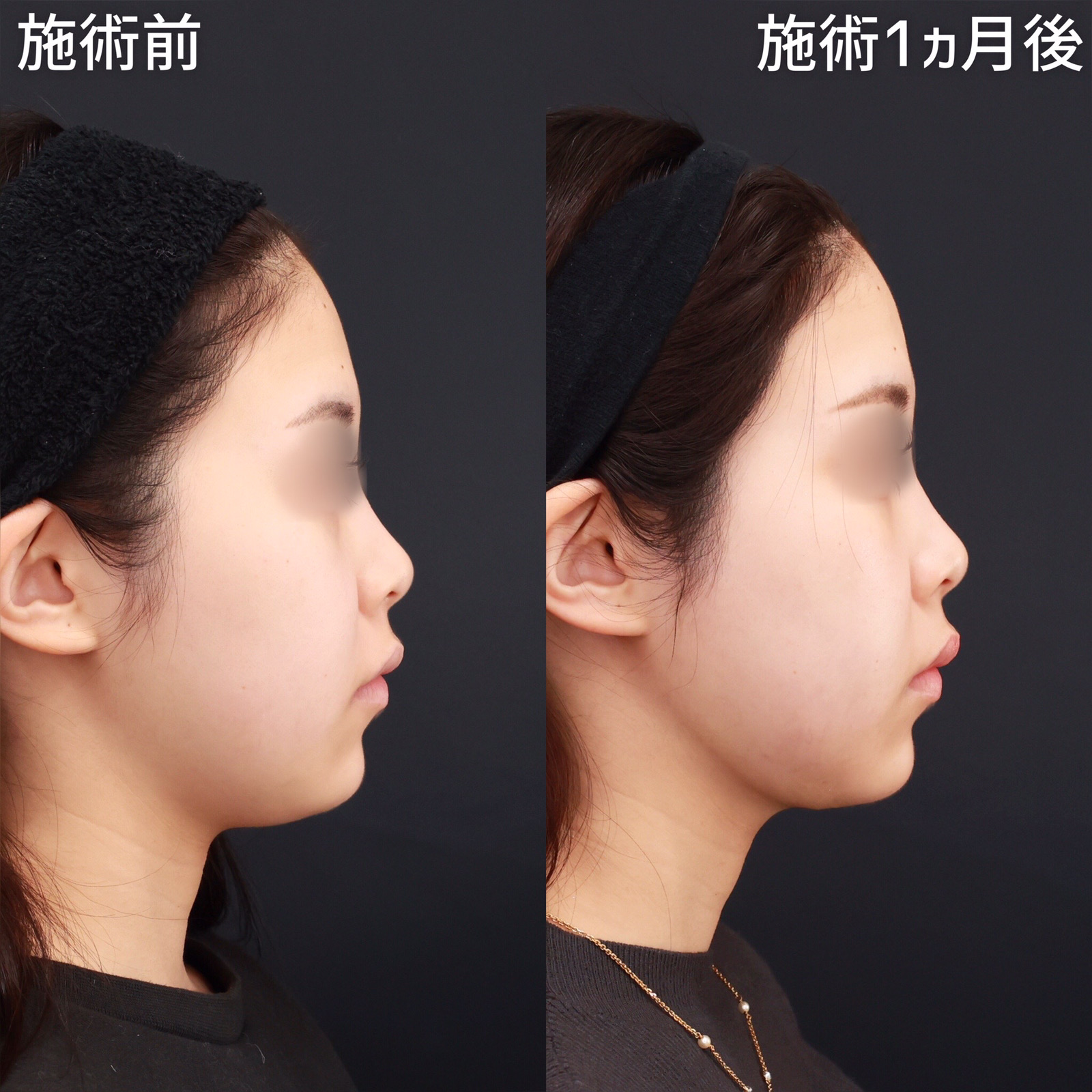 ジョールファット除去/TAC式 ツヤ肌コラーゲンリフト®/Lラインファット除去（エラ下脂肪除去）の症例写真 施術前後 