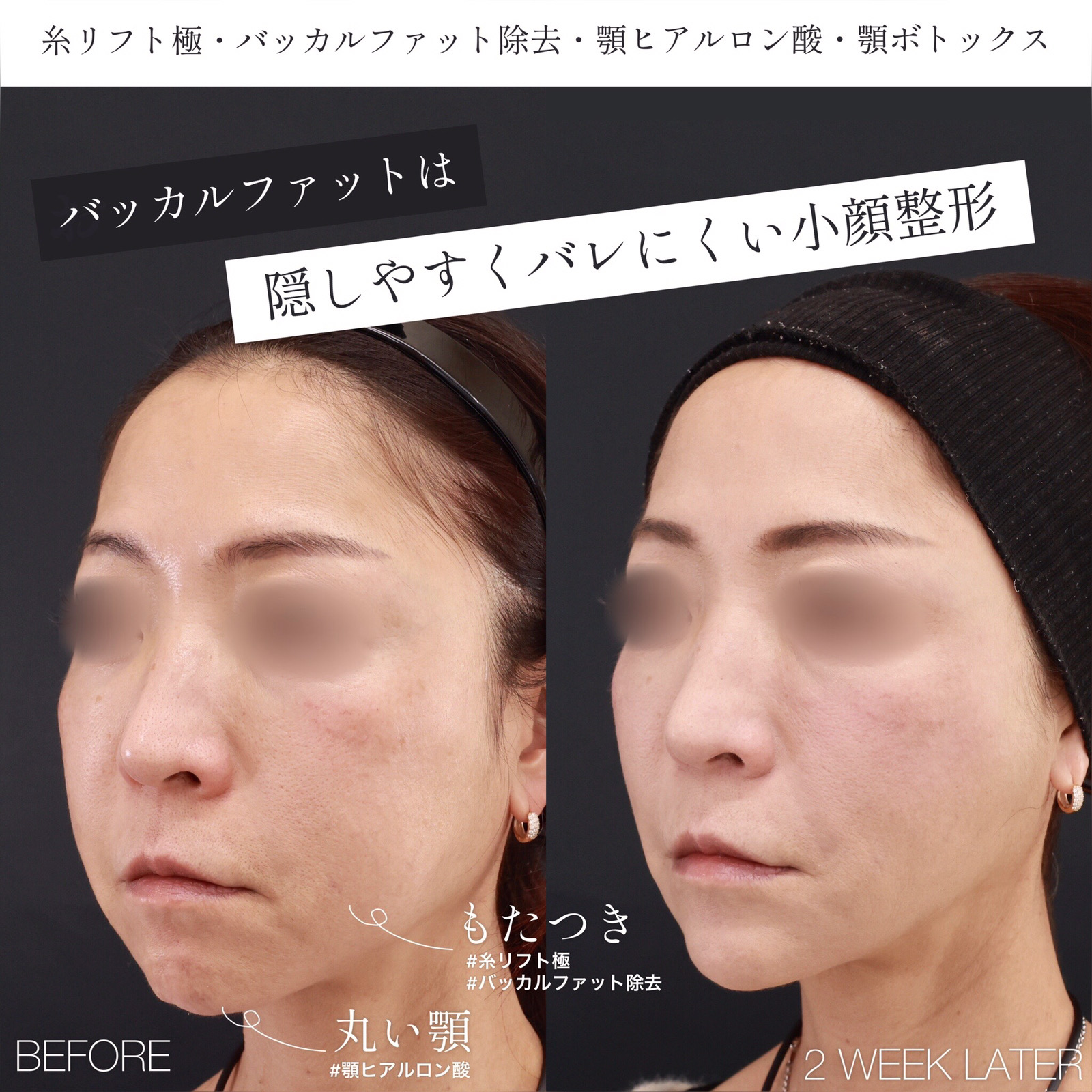 バッカルファット除去/TAC式 ツヤ肌コラーゲンリフト®/顎のヒアルロン酸注射の症例写真 施術前後