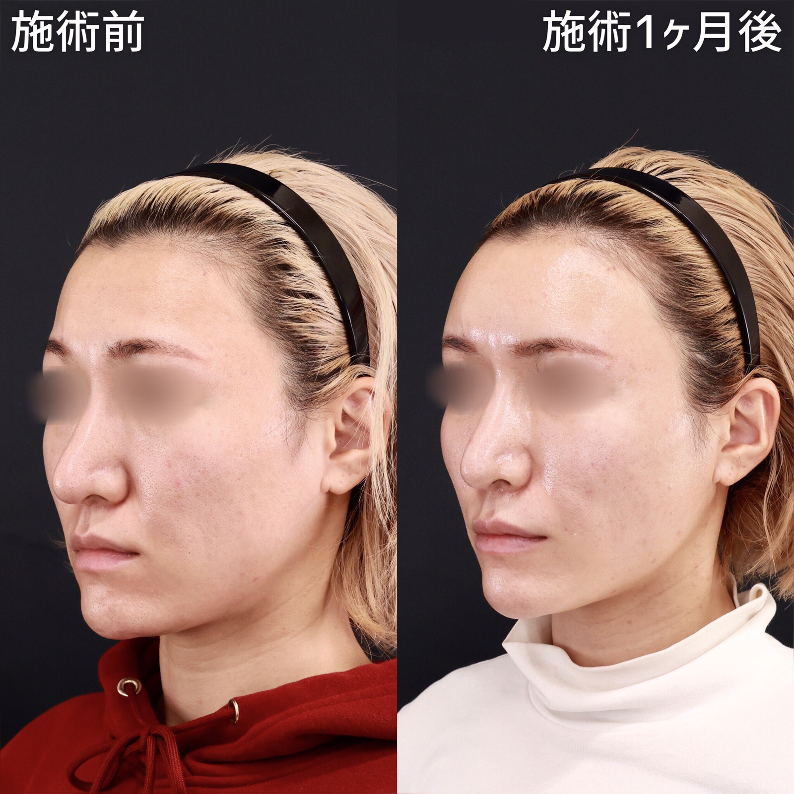 顔の脂肪注入(コンデンスリッチフェイス)/下眼瞼脱脂術(目の下のたるみ取り・目の下の脂肪ふくらみ取り)/TAC式 ツヤ肌コラーゲンリフト®の症例写真 施術前後