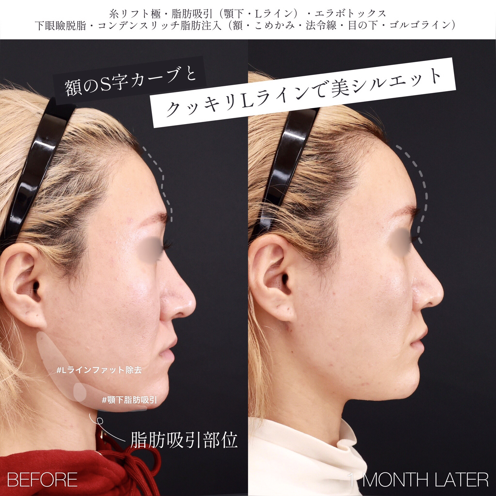 顔の脂肪注入(コンデンスリッチフェイス)/下眼瞼脱脂術(目の下のたるみ取り・目の下の脂肪ふくらみ取り)/TAC式 ツヤ肌コラーゲンリフト®の症例写真 施術前後